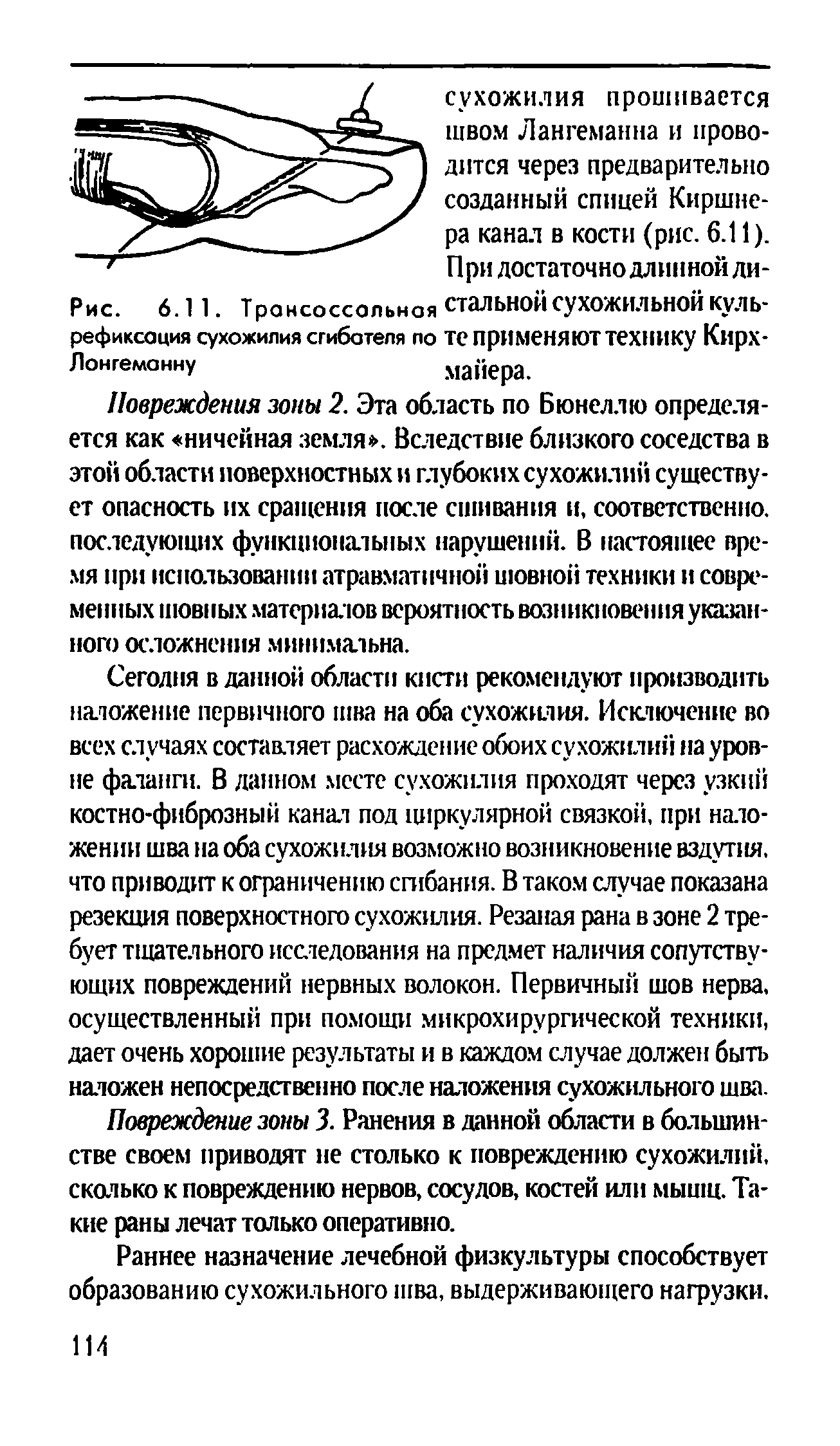 Рис. 6.11. Трансоссольноя стальной сухожильной куль-рефиксация сухожилия сгибателя по те применяют технику Кирх-...