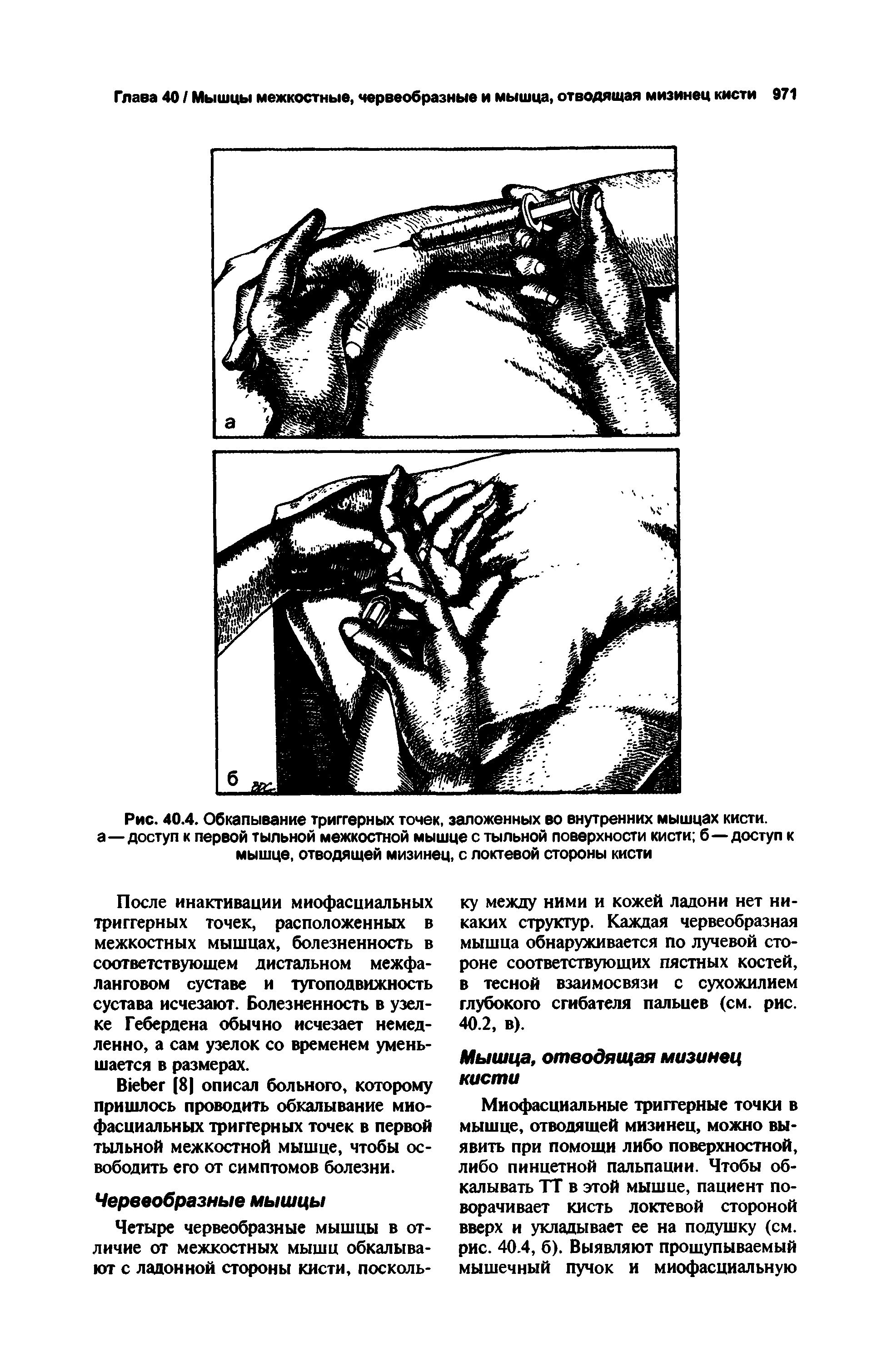 Рис. 40.4. Обкапывание триггерных точек, заложенных во внутренних мышцах кисти, а—доступ к первой тыльной межкостной мышце с тыльной поверхности кисти б—доступ к мышце, отводящей мизинец, с локтевой стороны кисти...