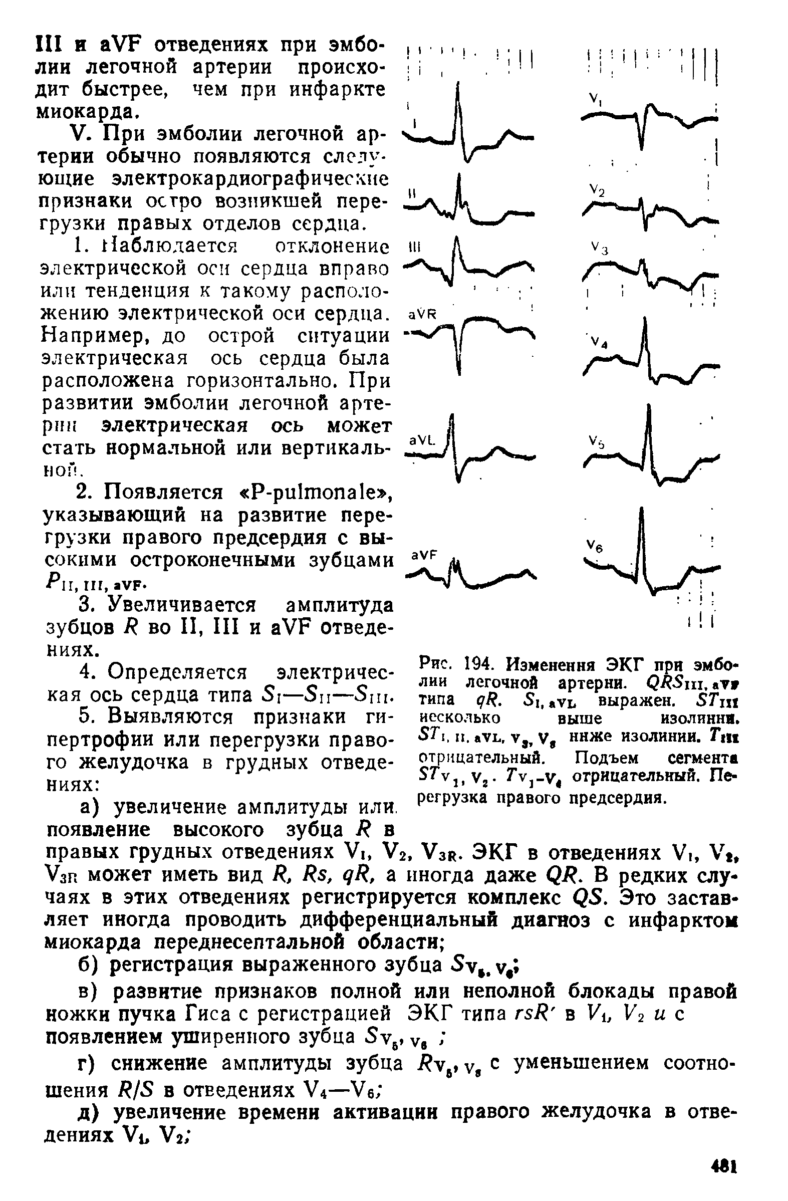 Рис. 194. Изменения ЭКГ при эмболии легочной артерии. С)Я гг1, V типа < / . ауь выражен. Тщ несколько выше изолинии. 5Г1, и. ать, у, V, ниже изолинии. Гт отрицательный. Подъем сегмента 5Гу1>у2- ГУ] у4 отрицательный. Перегрузка правого предсердия.