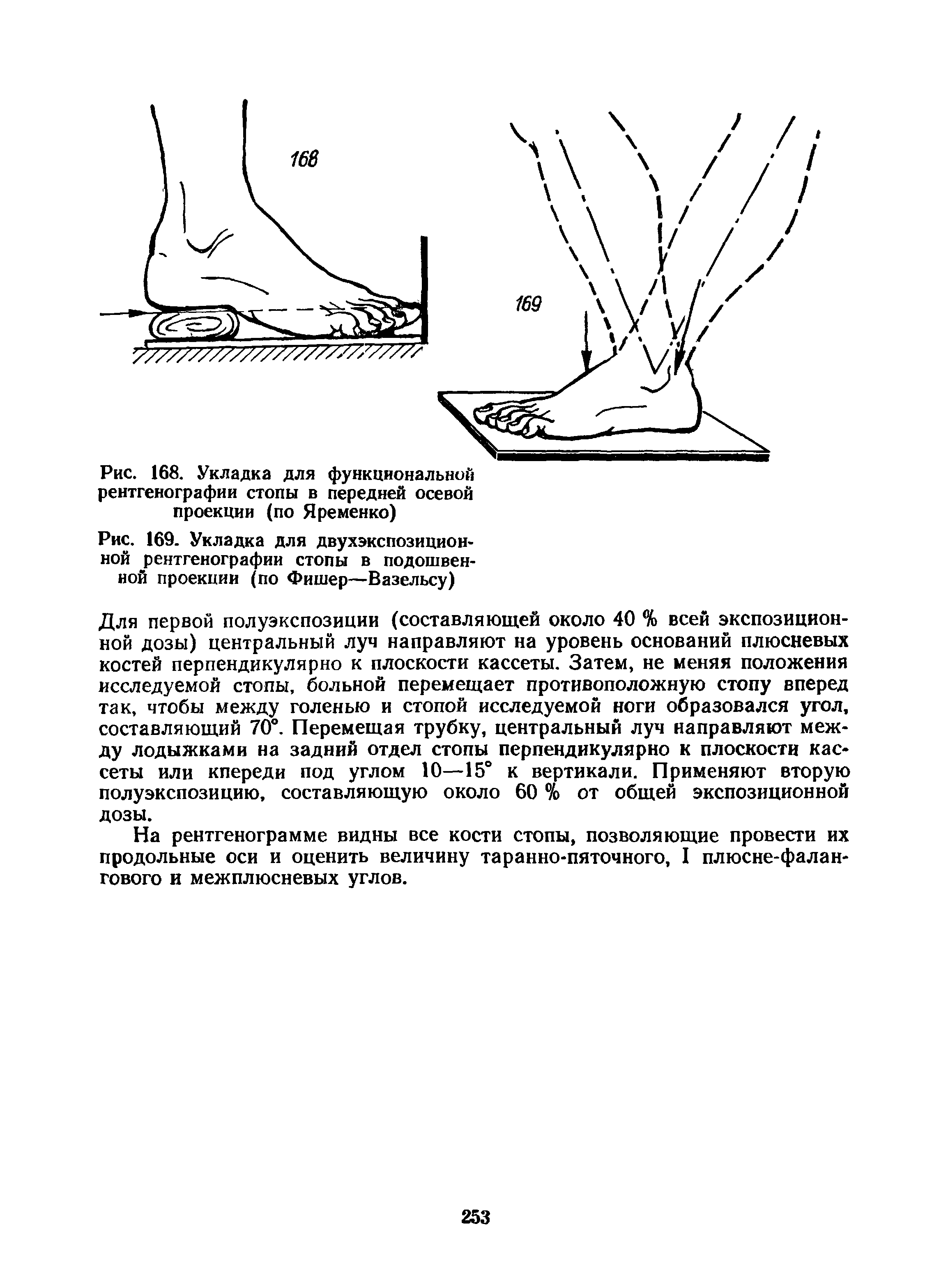 Рис. 169. Укладка для двухэкспозиционной рентгенографии стопы в подошвенной проекции (по Фишер—Вазельсу)...