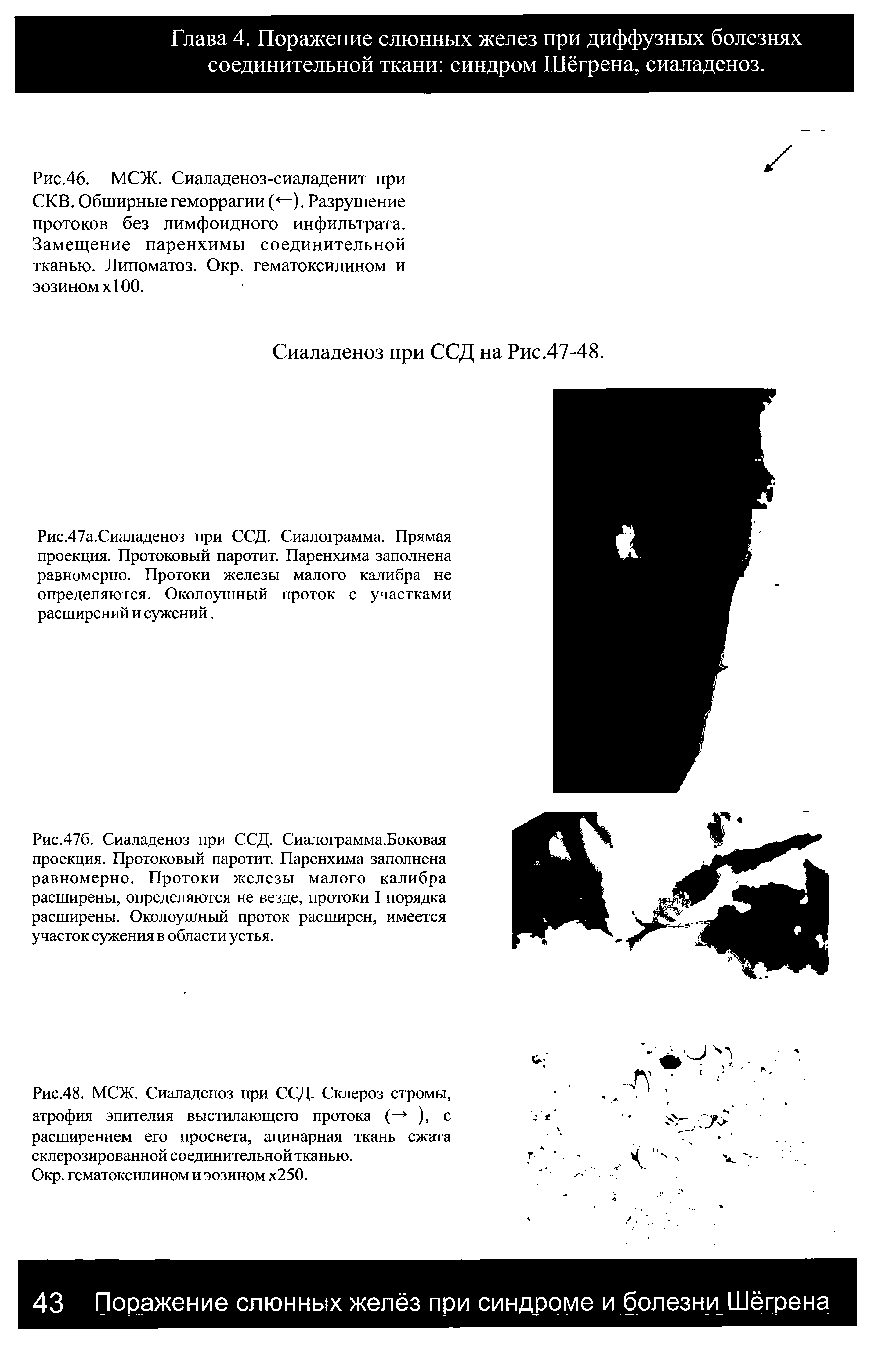 Рис.46. МСЖ. Сиаладеноз-сиаладенит при СКВ. Обширные геморрагии (<—). Разрушение протоков без лимфоидного инфильтрата. Замещение паренхимы соединительной тканью. Липоматоз. Окр. гематоксилином и эозином х 100.