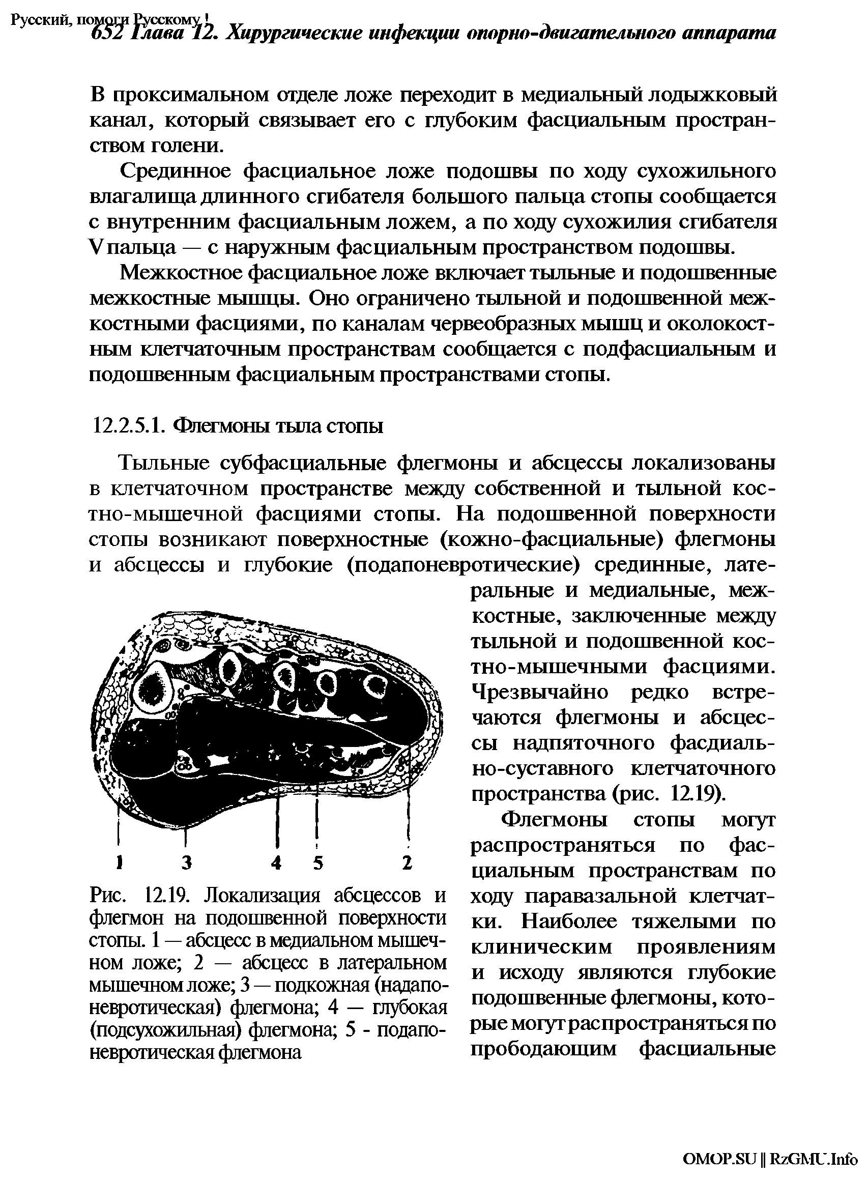 Рис. 12.19. Локализация абсцессов и флегмон на подошвенной поверхности стопы. 1 — абсцесс в медиальном мышечном ложе 2 — абсцесс в латеральном мышечном ложе 3 — подкожная (надапоневротическая) флегмона 4 — глубокая (подсухожильная) флегмона 5 - подапоневротическая флегмона...