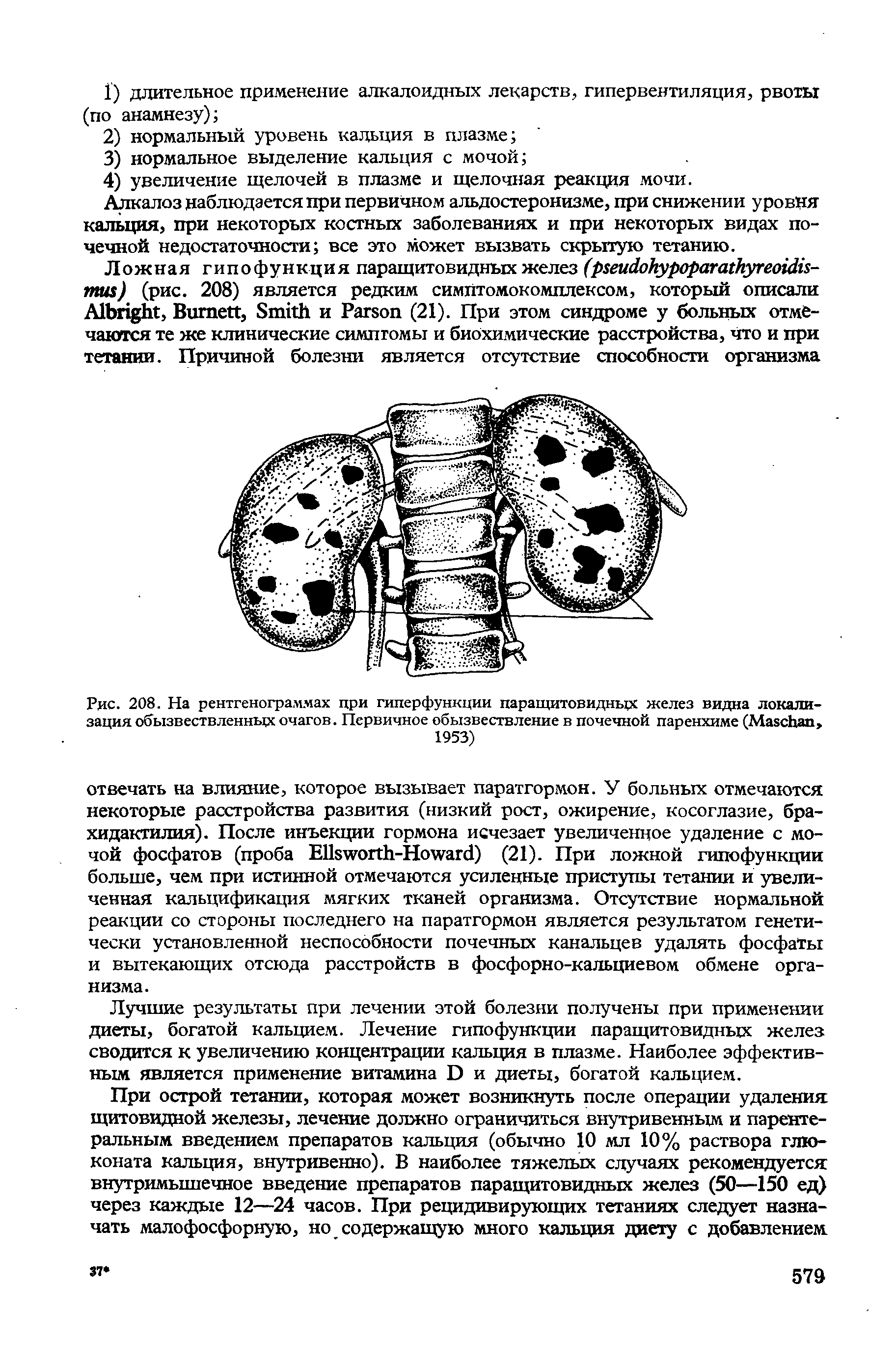 Рис. 208. На рентгенограммах при гиперфункции паращитовидных желез видна локализация обызвествленных очагов. Первичное обызвествление в почечной паренхиме (МаасЬап, 1953)...