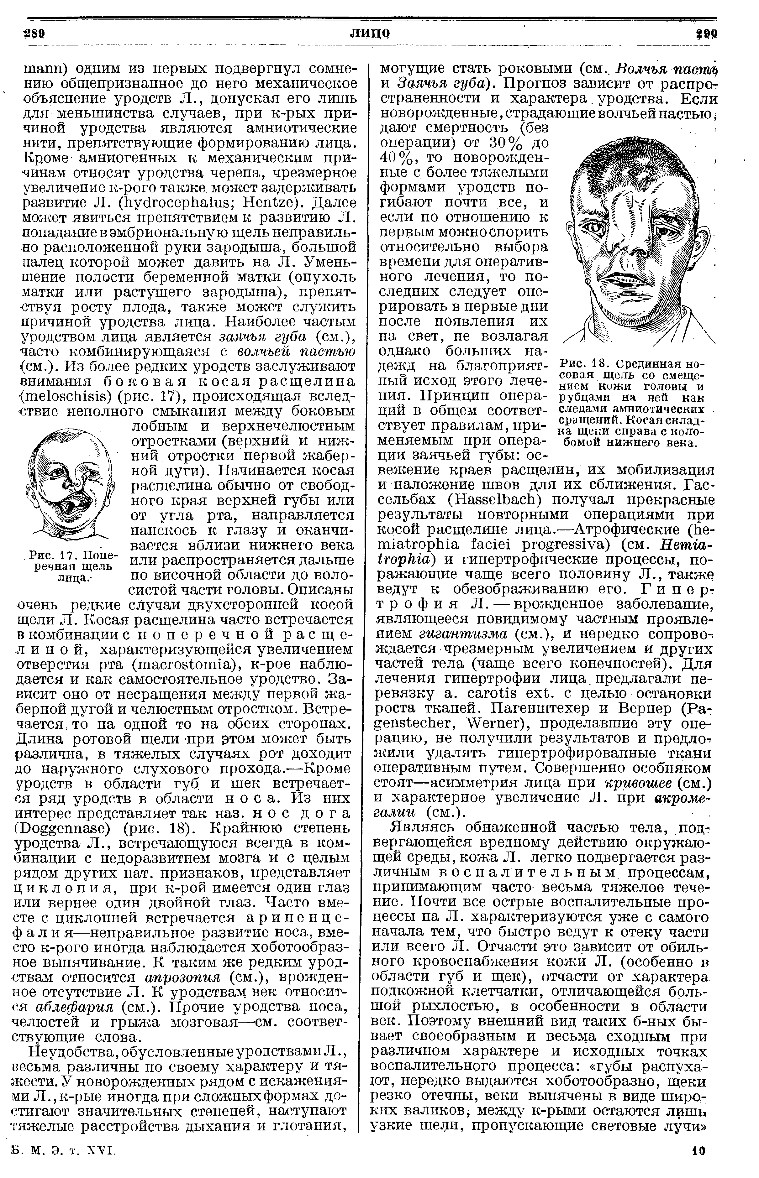 Рис. 18. Срединная носовая щель со смещением кожи головы и рубцами на ней как следами амниотических сращений. Косая складка щеки справа с колобомой нижнего века.