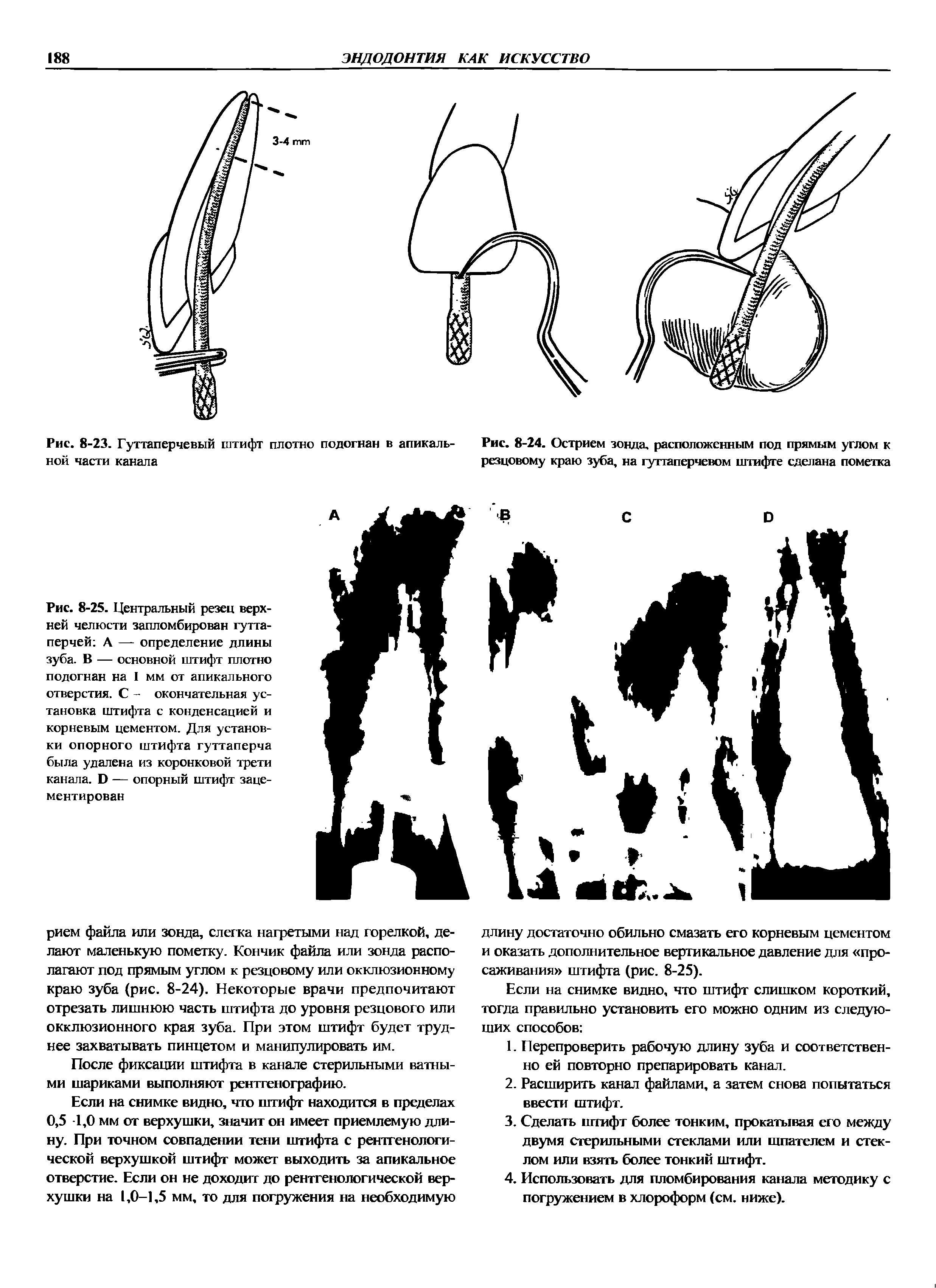 Рис. 8-23. Гуттаперчевый штифт плотно подогнан в апикаль- Рис. 8-24. Острием зонда, расположенным под прямым углом к ной части канала резцовому краю зуба, на гуттаперчевом штифте сделана пометка...