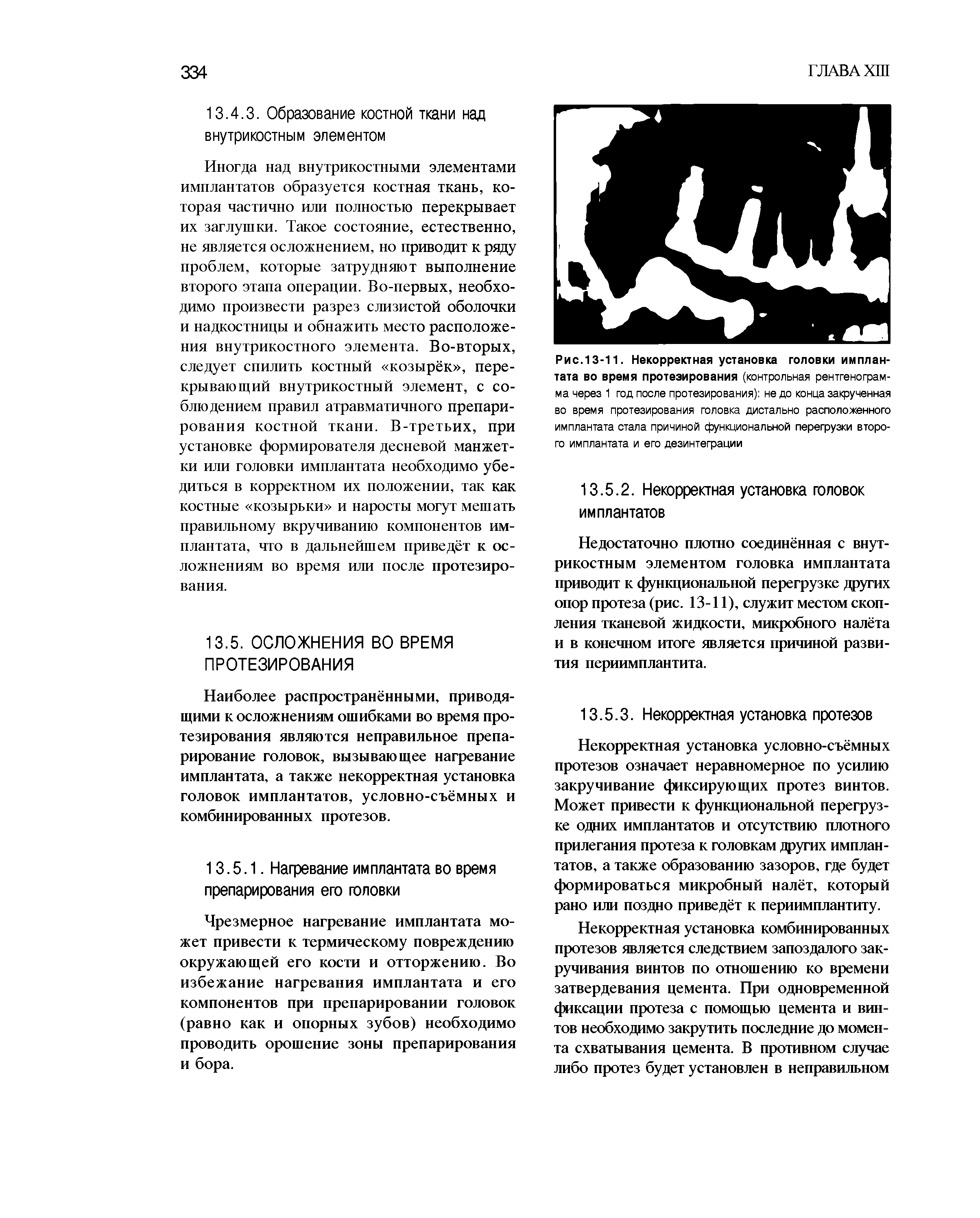 Рис.13-11. Некорректная установка головки имплантата во время протезирования (контрольная рентгенограмма через 1 год после протезирования) не до конца закрученная во время протезирования головка дистально расположенного имплантата стала причиной функциональной перегрузки второго имплантата и его дезинтеграции...