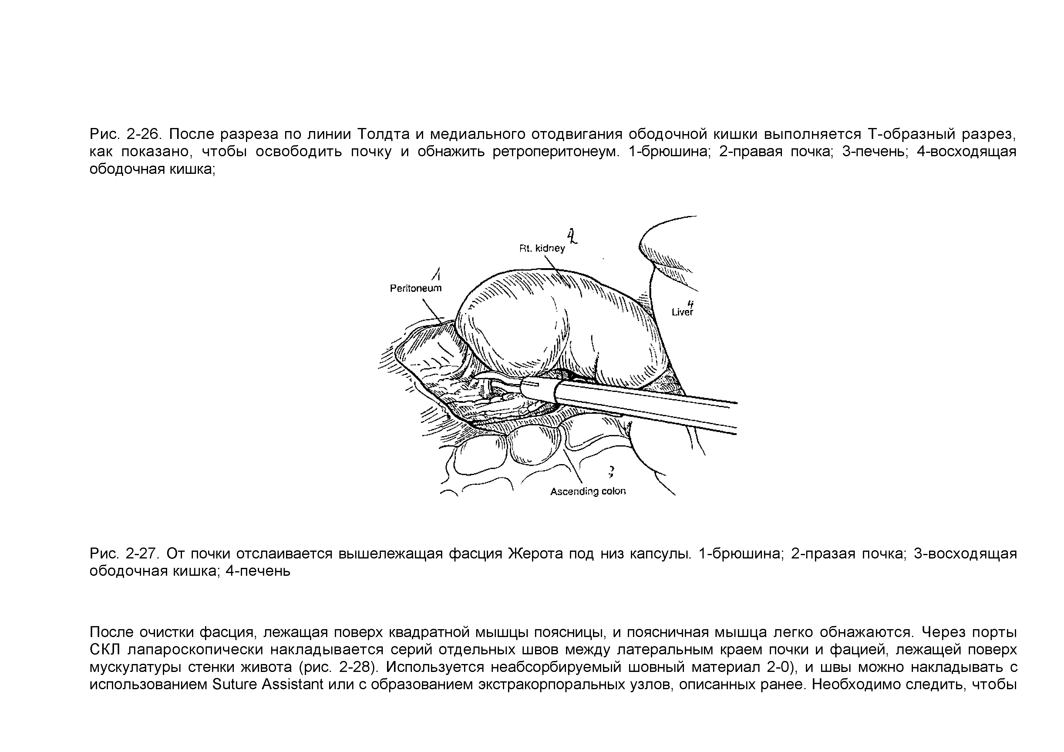 Рис. 2-27. От почки отслаивается вышележащая фасция Жерота под низ капсулы. 1-брюшина 2-празая почка 3-восходящая ободочная кишка 4-печень...