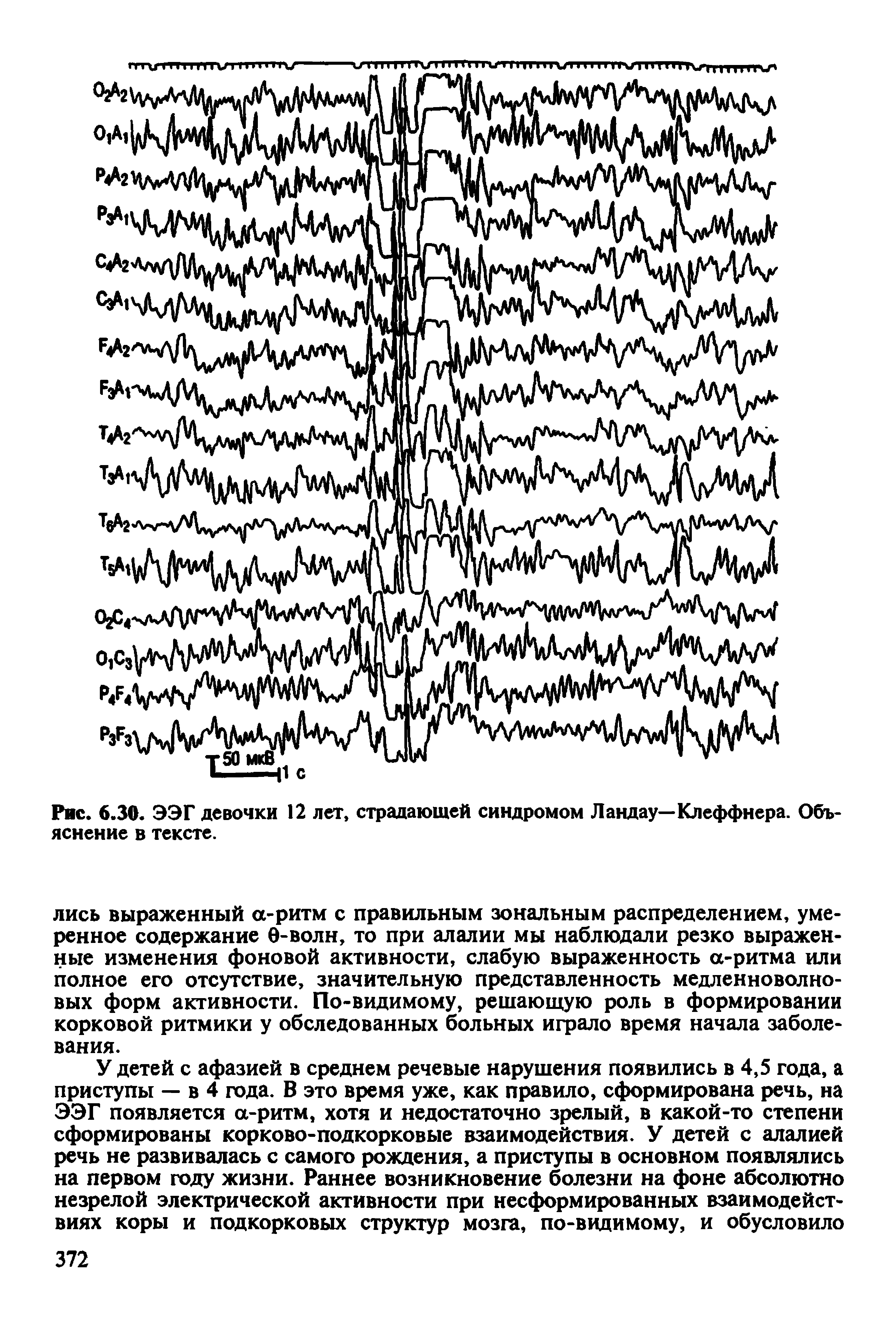 Рис. 6.30. ЭЭГ девочки 12 лет, страдающей синдромом Ландау—Клеффнера. Объяснение в тексте.