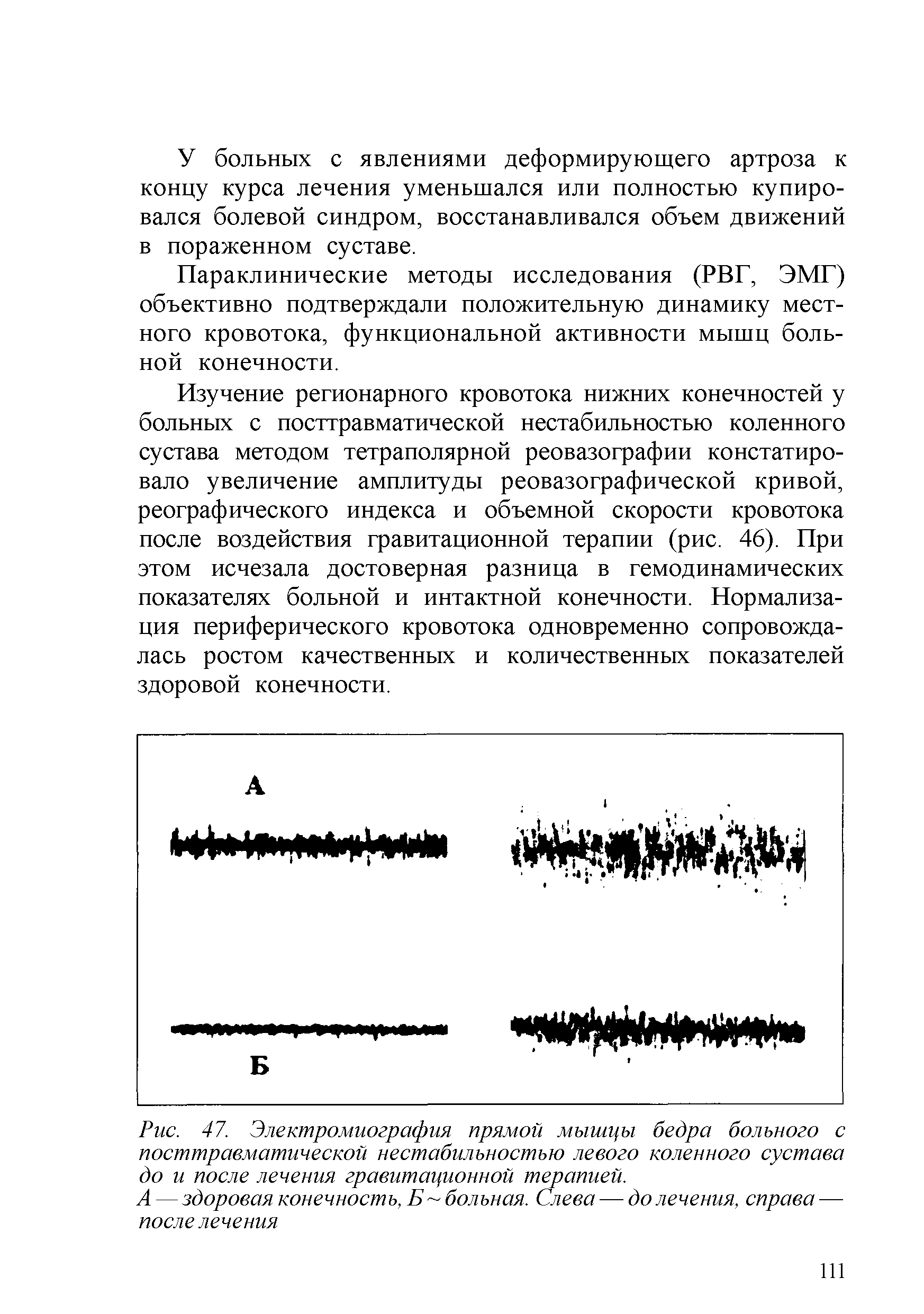 Рис. 47. Электромиография прямой мышцы бедра больного с посттравматической нестабильностью левого коленного сустава до и после лечения гравитационной терапией.