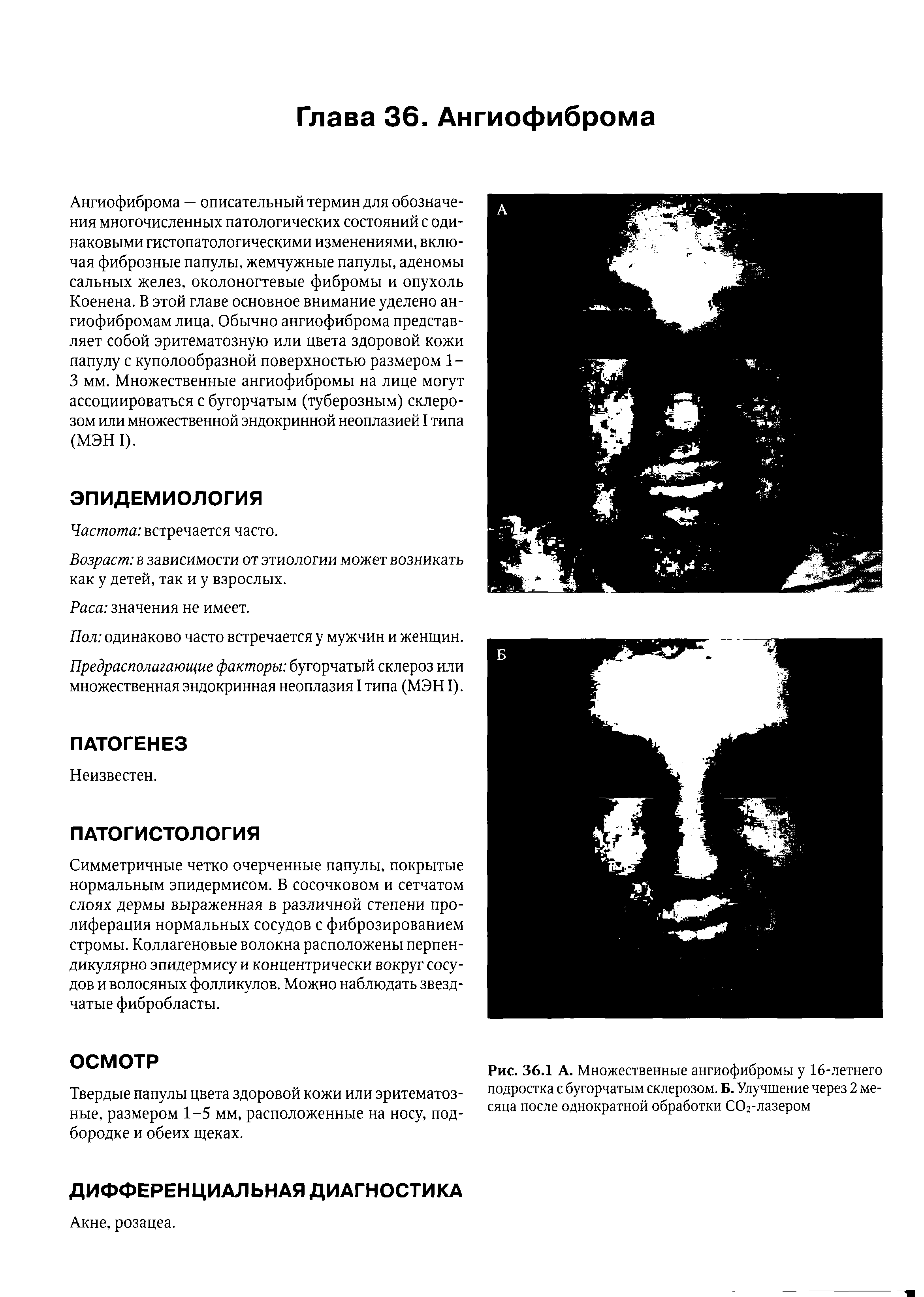 Рис. 36.1 А. Множественные ангиофибромы у 16-летнего подростка с бугорчатым склерозом. Б. Улучшение через 2 месяца после однократной обработки СО2-лазером...