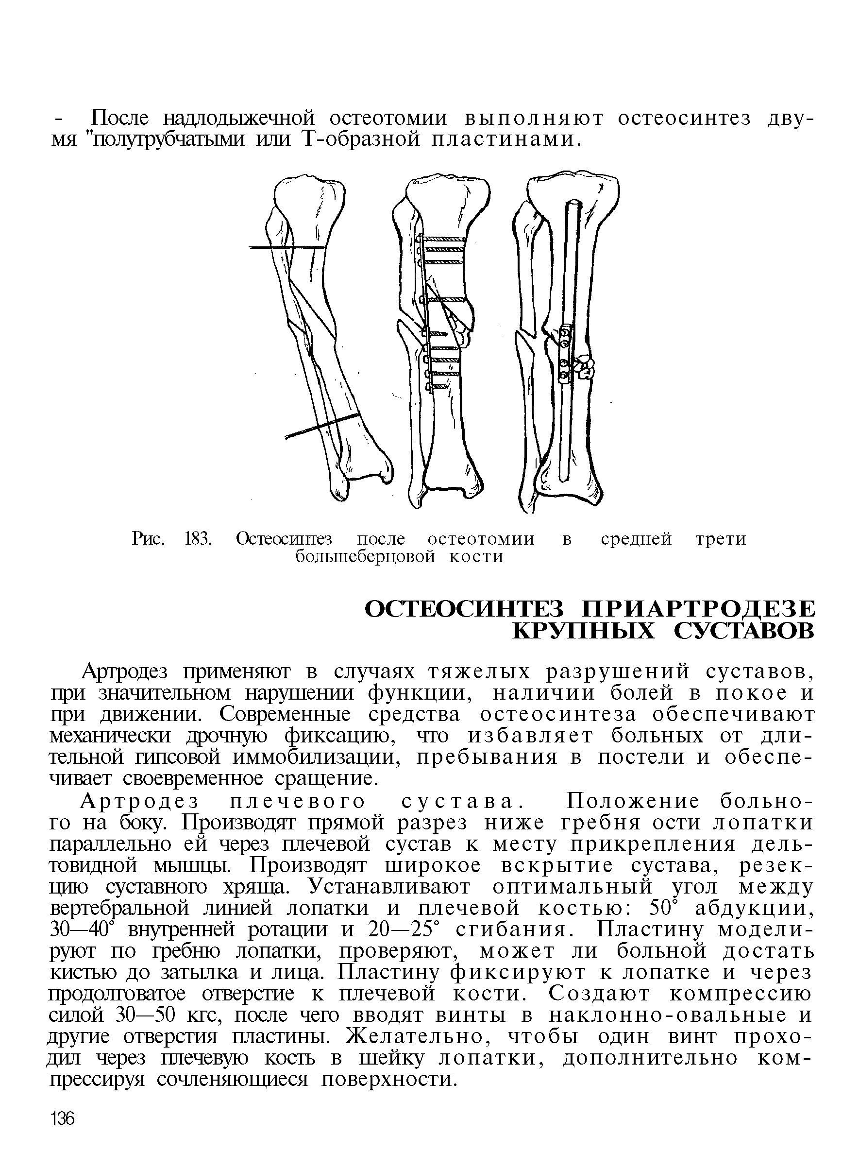 Рис. 183. Остеосинтез после остеотомии в средней трети большеберцовой кости...