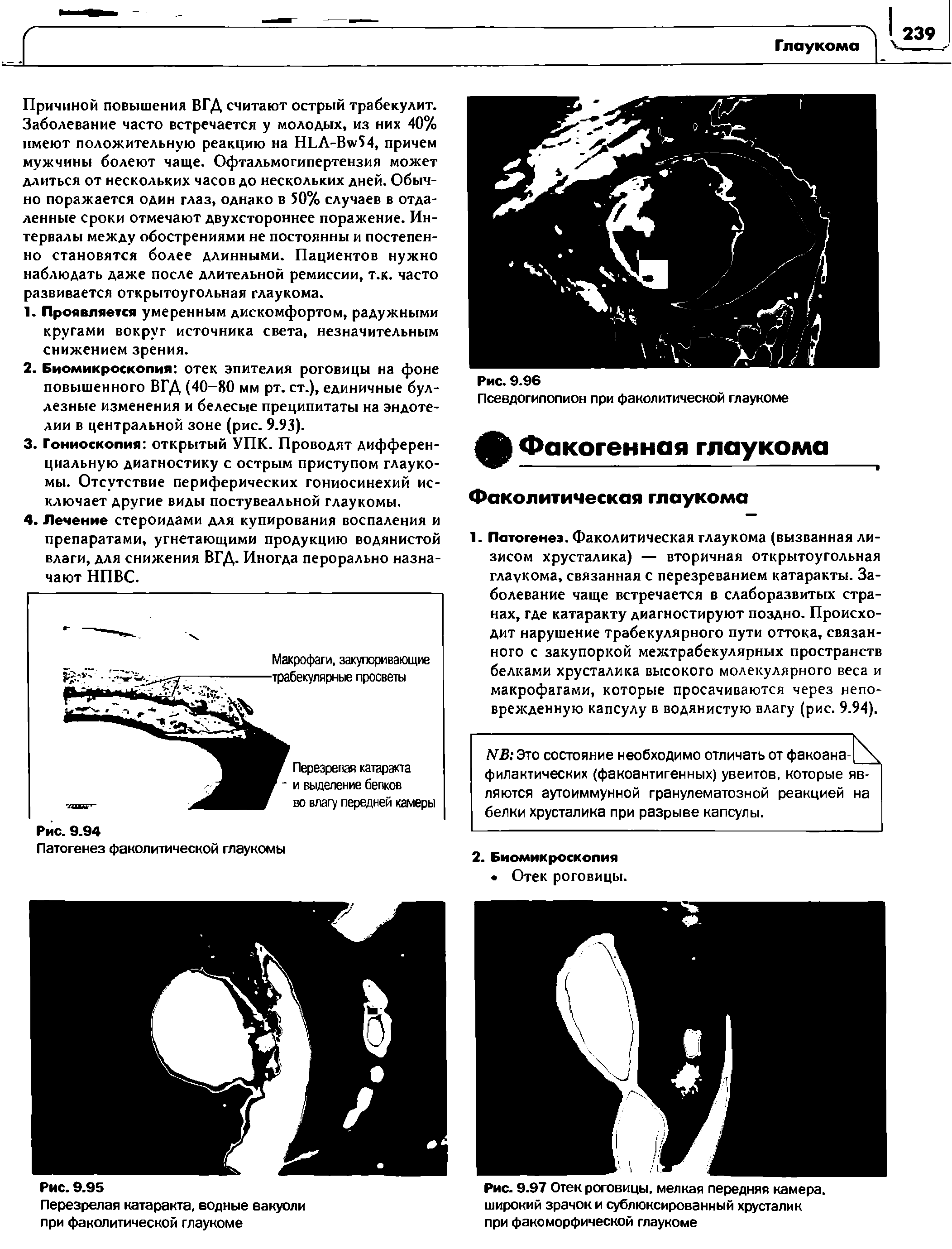 Рис. 9.97 Отек роговицы, мелкая передняя камера, широкий зрачок и сублюксированный хрусталик при факоморфической глаукоме...