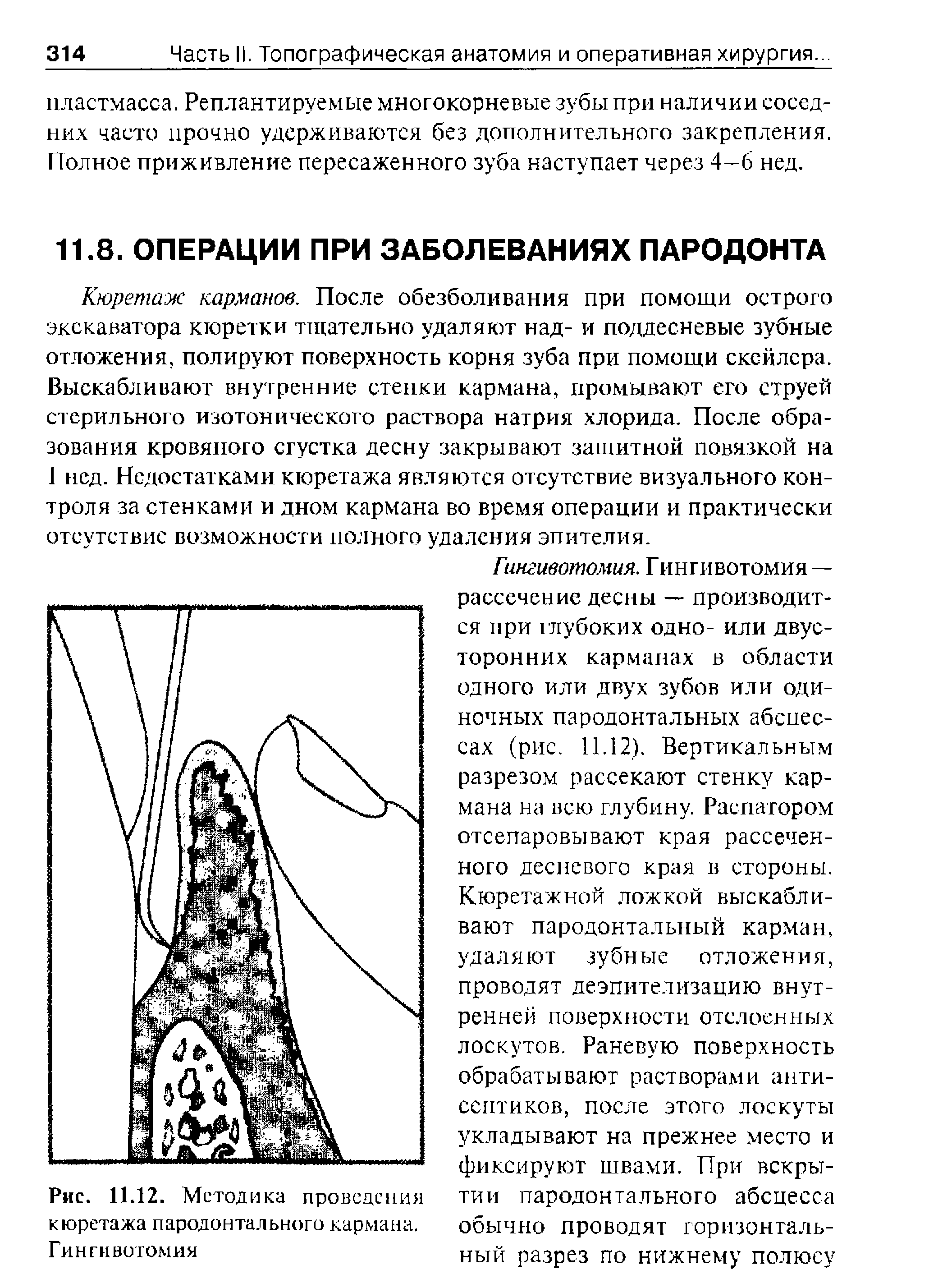 Рис. 11.12. Методика проведения кюретажа пародонтального кармана. Гингнвотомия...