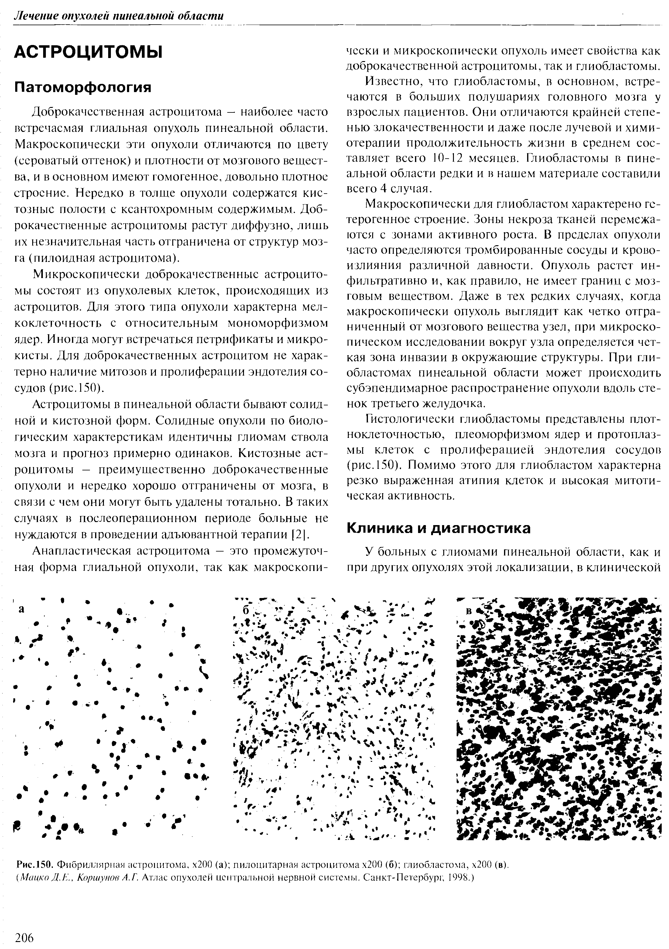 Рис.150. Фибриллярная астроцитома. х200 (а) пилоцитарная астроцитома х2(Ю (б) глиобластома, х200 (в).