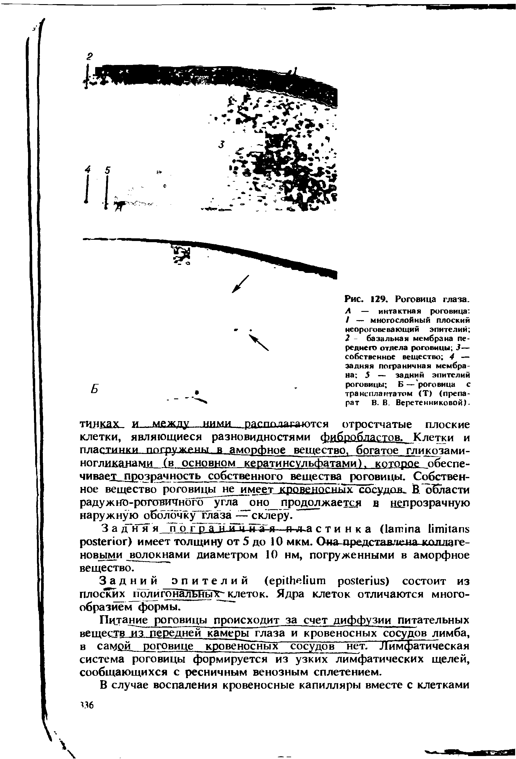 Рис. 129. Роговица глаза. А — интактная роговица / — многослойный плоский неорогове ва ющий эпителий 2 - базальная мембрана переднего отдела роговицы 3— собственное вещество 4 — задняя пограничная мембрана 5 — задний эпителий роговицы Б— роговица с трансплантатом (Т) (препарат В. В. Веретенниковой).