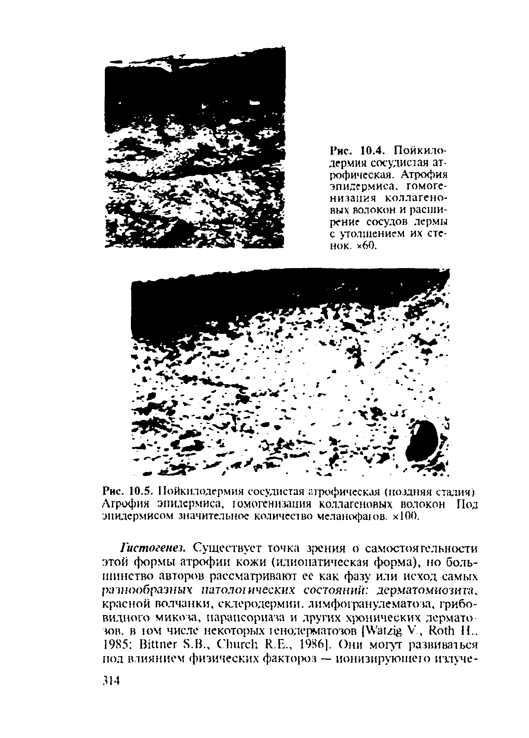 Рис. 10.5. Пойкилодермия сосудистая атрофическая (поздняя стадия) /Чгрофия эпидермиса, юмогенизания коллагеновых волокон Под эпидермисом значительное количество меланофаюв. хЮО.