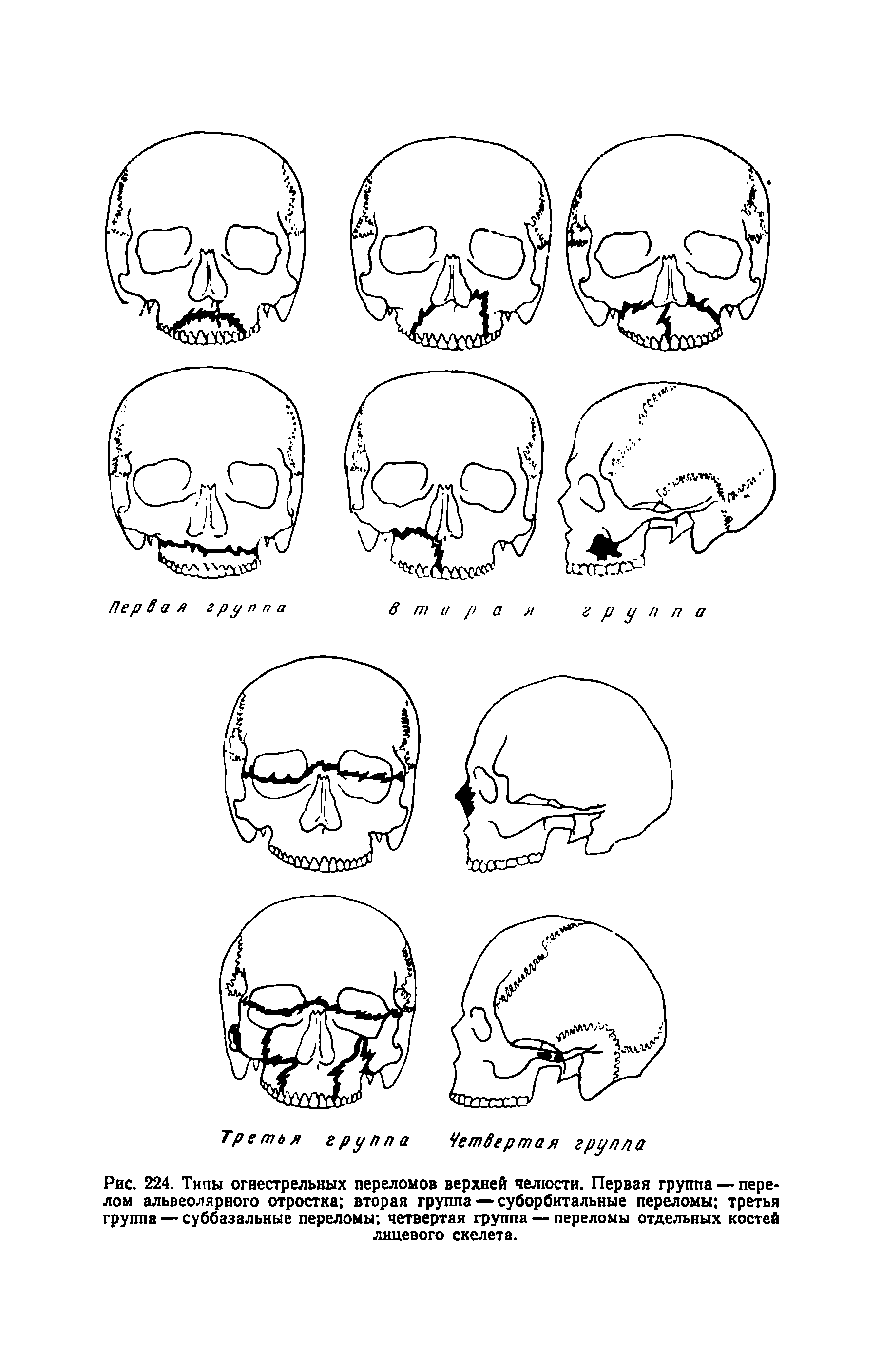Рис. 224. Типы огнестрельных переломов верхней челюсти. Первая группа — перелом альвеолярного отростка вторая группа — суборбитальные переломы третья группа — суббазальные переломы четвертая группа — переломы отдельных костей лицевого скелета.