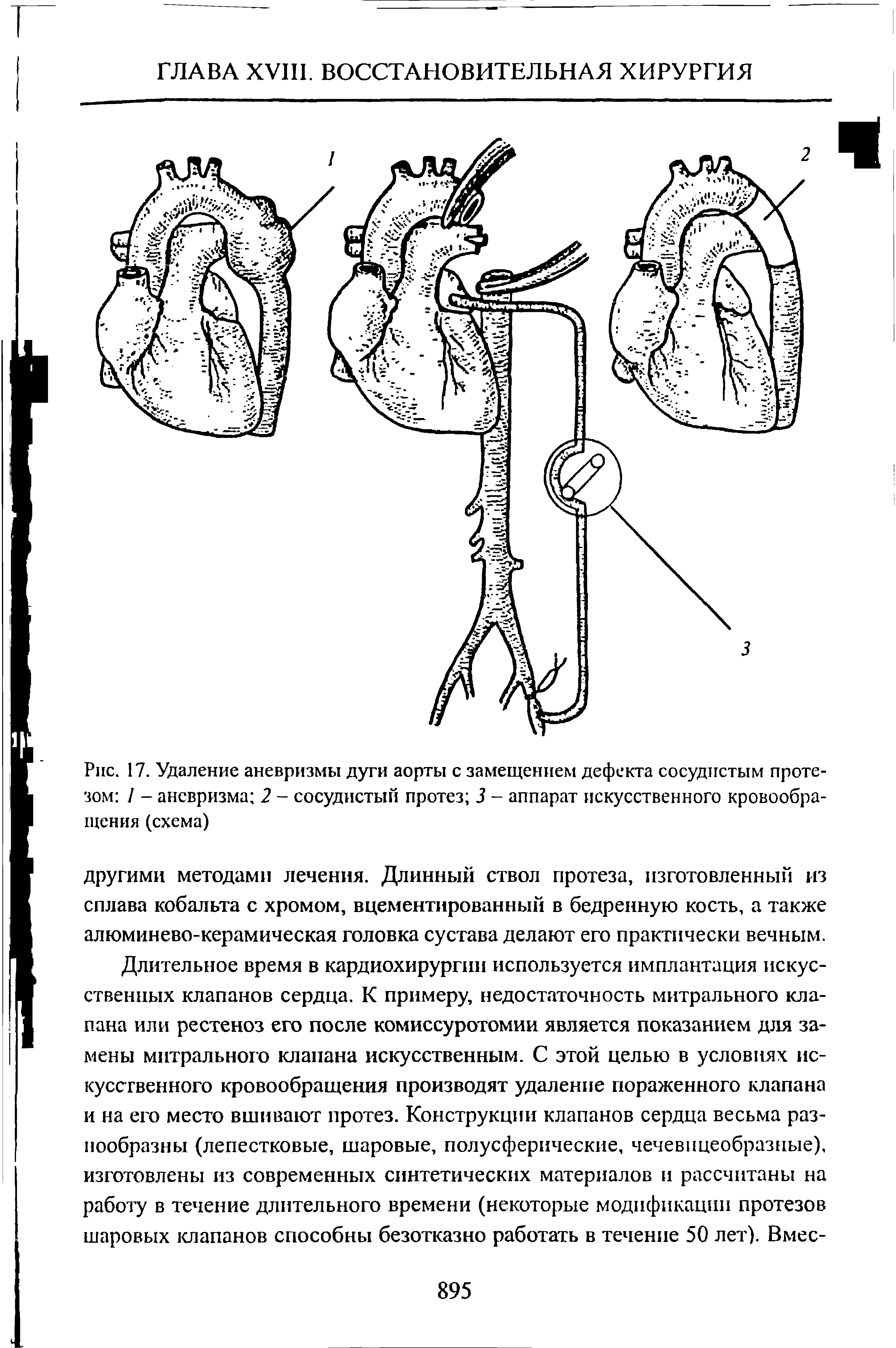 Рис. 17. Удаление аневризмы дуги аорты с замещением дефекта сосудистым протезом 1 - аневризма 2 - сосудистый протез 3 - аппарат искусственного кровообращения (схема)...