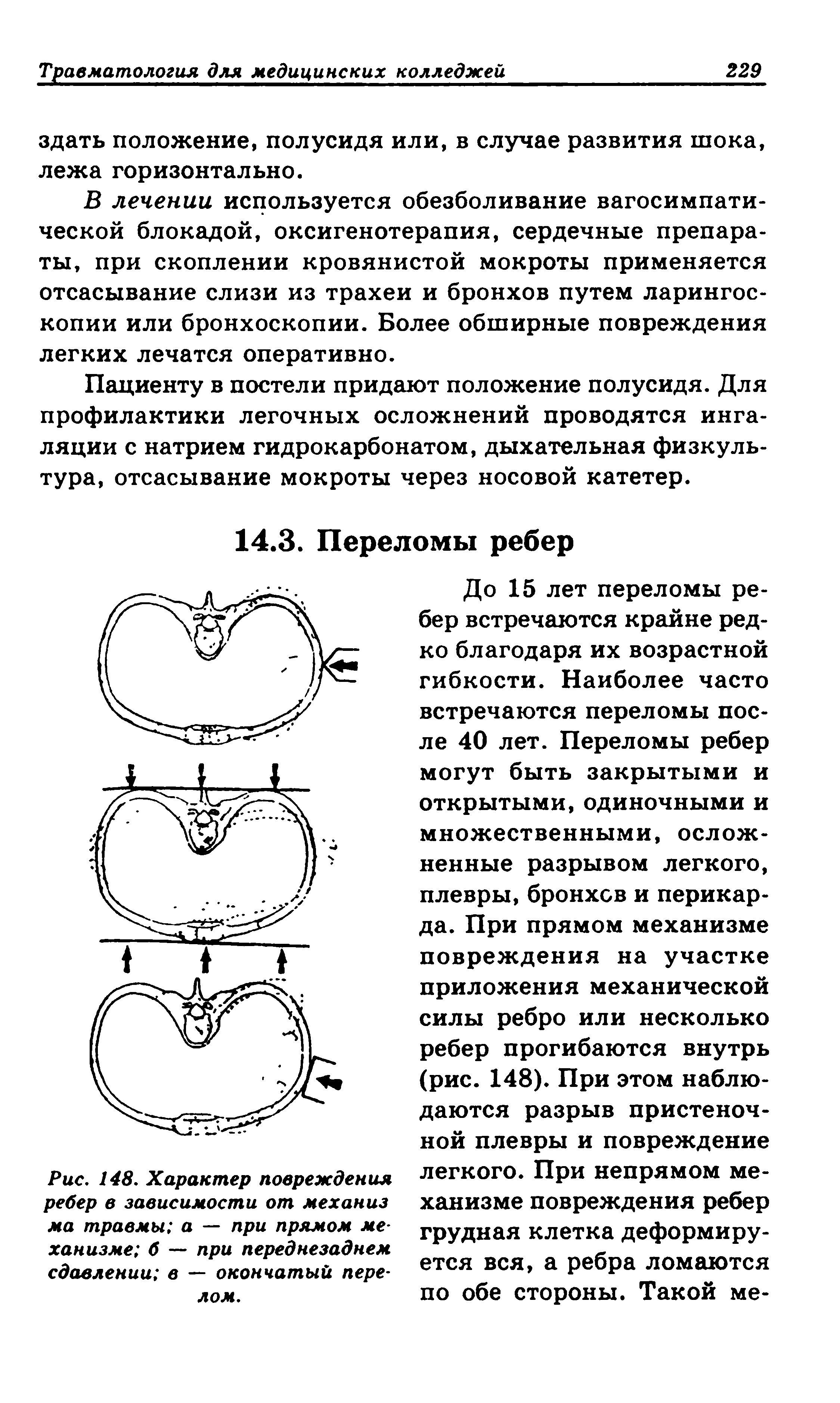 Рис. 148. Характер повреждения ребер в зависимости от механиз ма травмы а — при прямом механизме б — при переднезаднем сдавлении в — окончатый перелом.