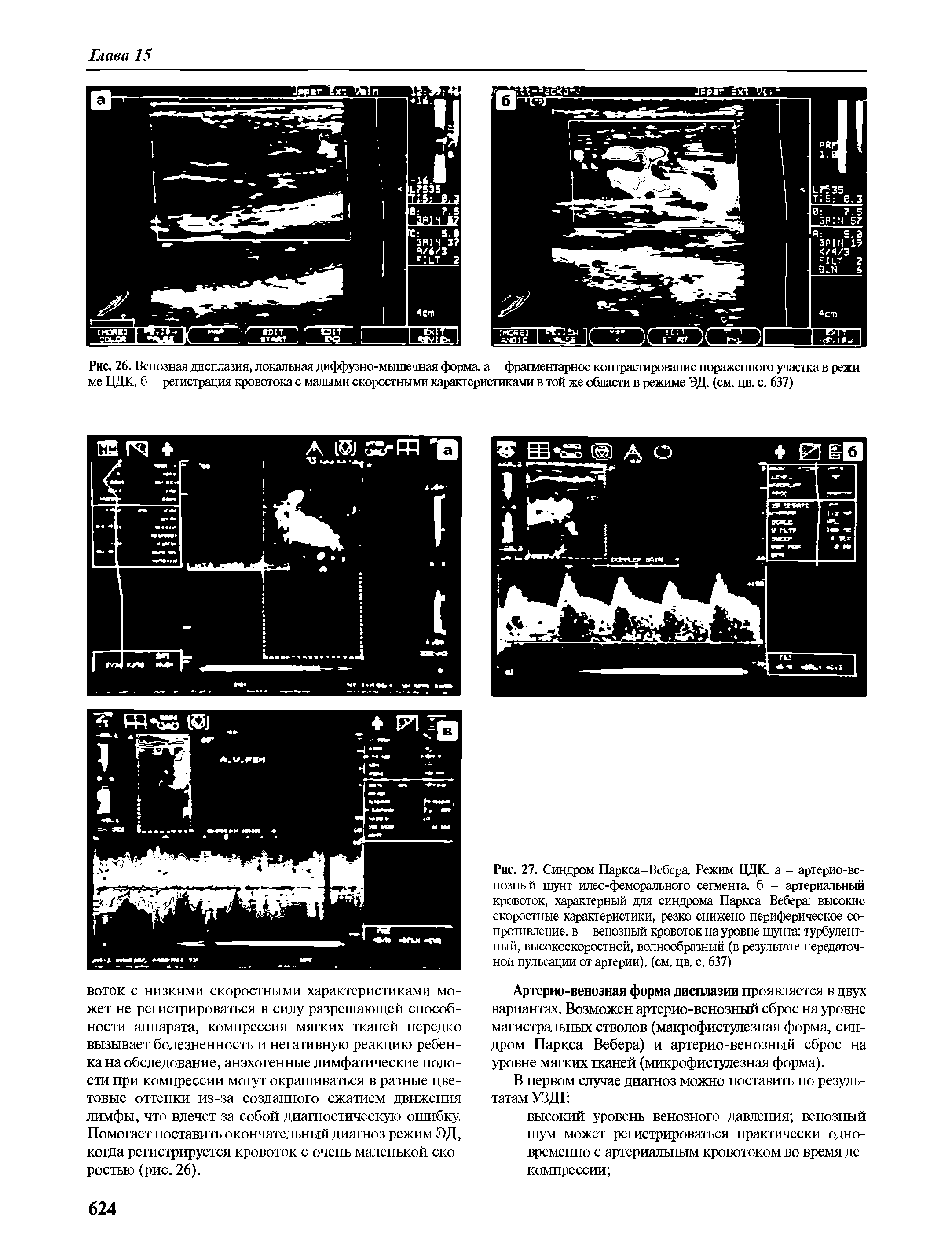 Рис. 27. Синдром Паркса-Вебера. Режим ЦДК. а - артерио-венозный шунт илео-феморального сегмента, б - артериальный кровоток, характерный для синдрома Паркса-Вебера высокие скоростные характеристики, резко снижено периферическое сопротивление. в венозный кровоток на уровне шунта турбулентный, высокоскоростной, волнообразный (в результате передаточной пульсации от артерии), (см. цв. с. 637)...