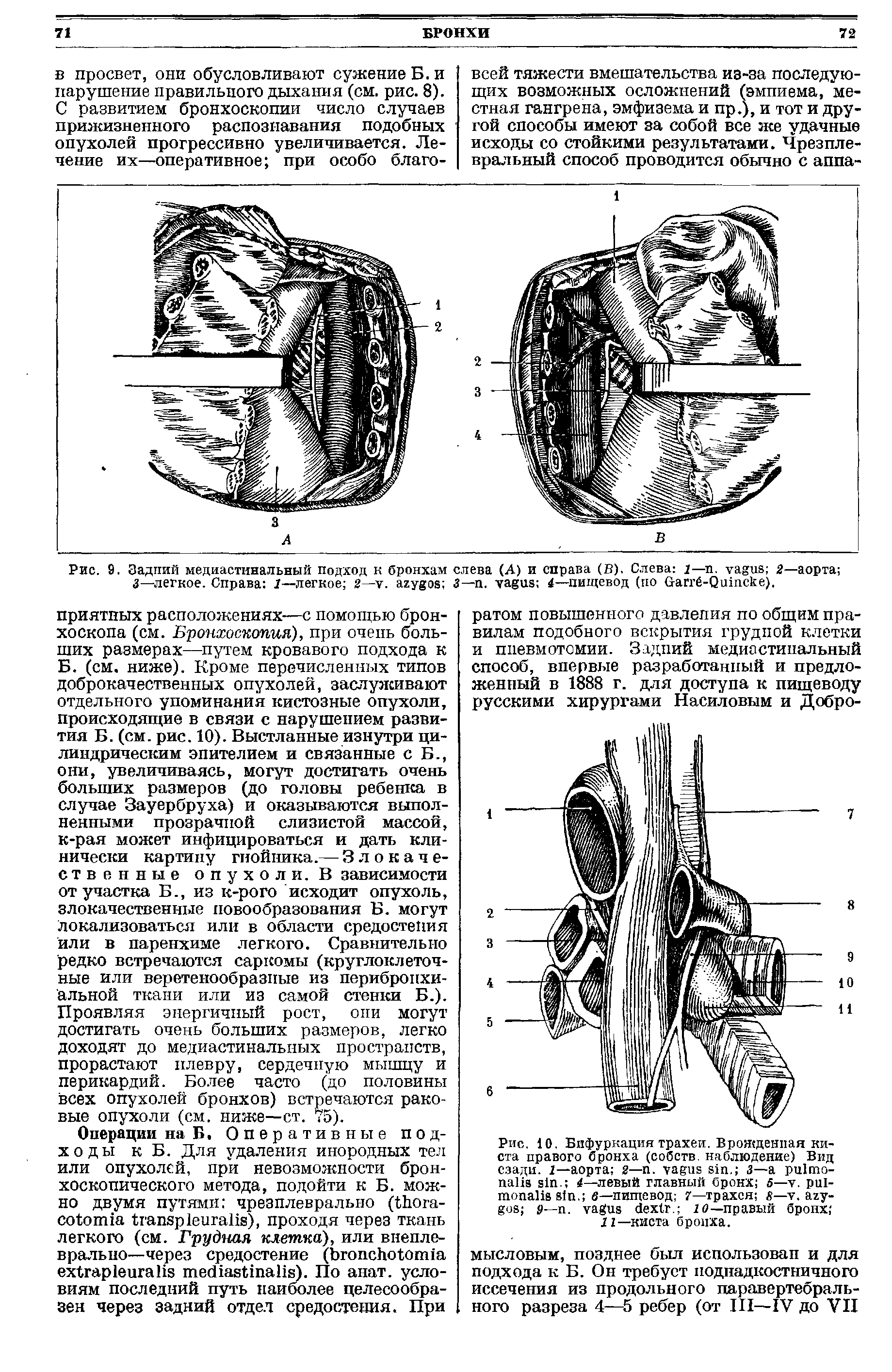 Рис. 10. Бифуркация трахеи. Врожденная киста правого бронха (собств. наблюдение) Вид сзади. 1—аорта 2— . . 3— - . —левый главный бронх 5— . - . в—пищевод 7—трахея 8— . — . . 2 —правый бронх ...