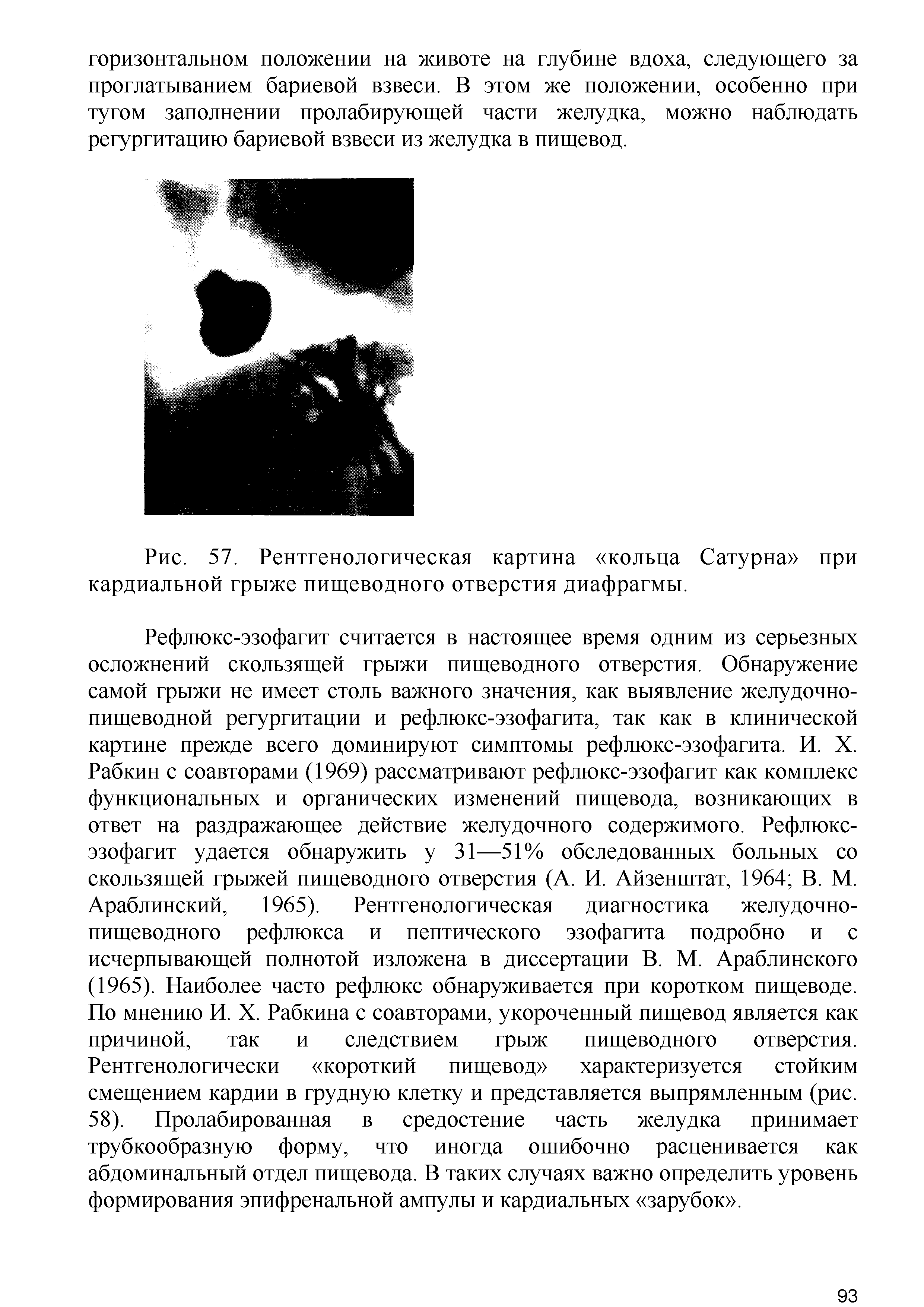 Рис. 57. Рентгенологическая картина кольца Сатурна при кардиальной грыже пищеводного отверстия диафрагмы.