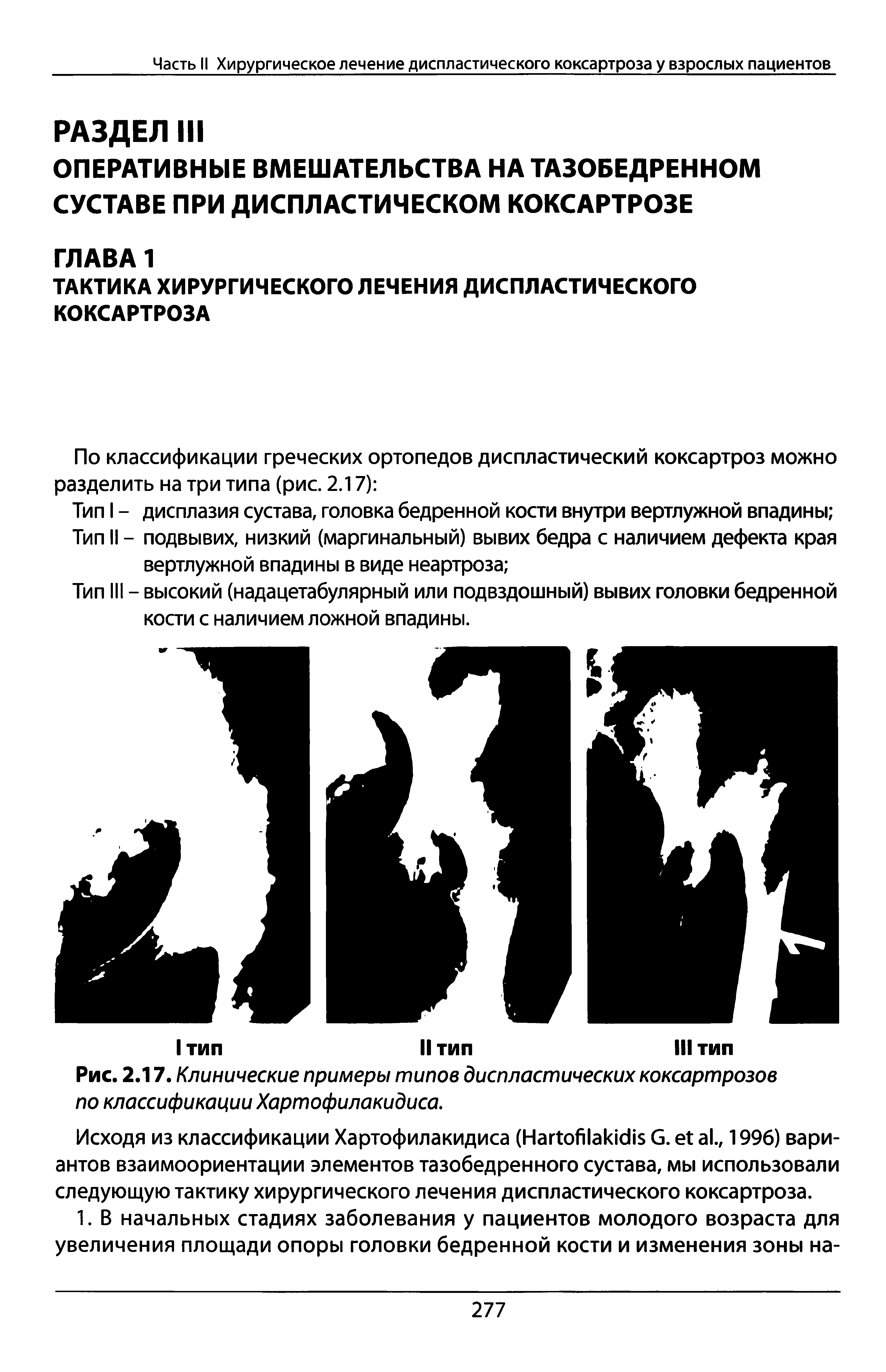 Рис. 2.17. Клинические примеры типов диспластических коксартрозов по классификации Хартофилакидиса.