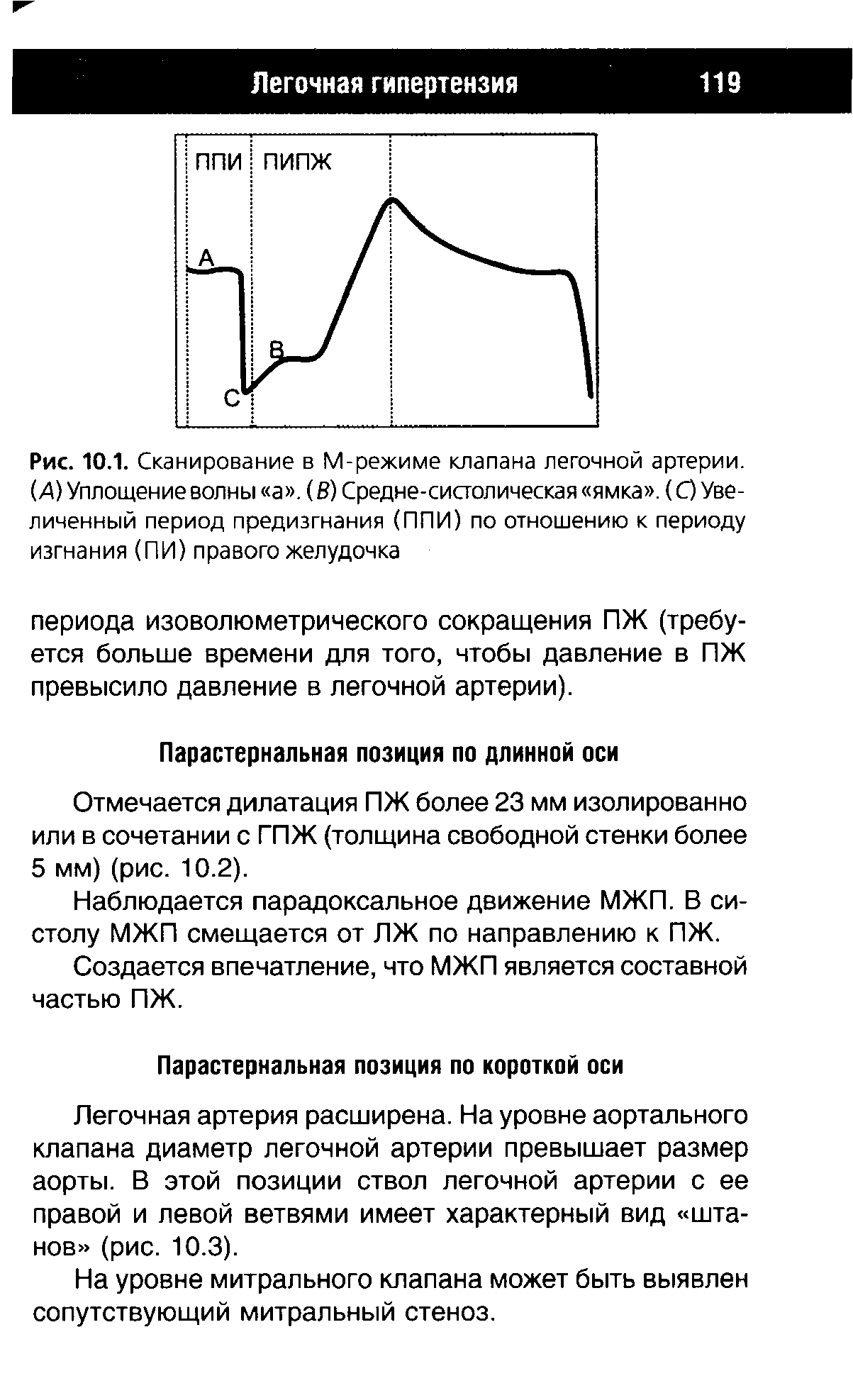 Рис. 10.1. Сканирование в М-режиме клапана легочной артерии. (А) Уплощение волны а . (В) Средне-систолическая ямка . (О Увеличенный период предизгнания (ППИ) по отношению к периоду изгнания (ПИ) правого желудочка...