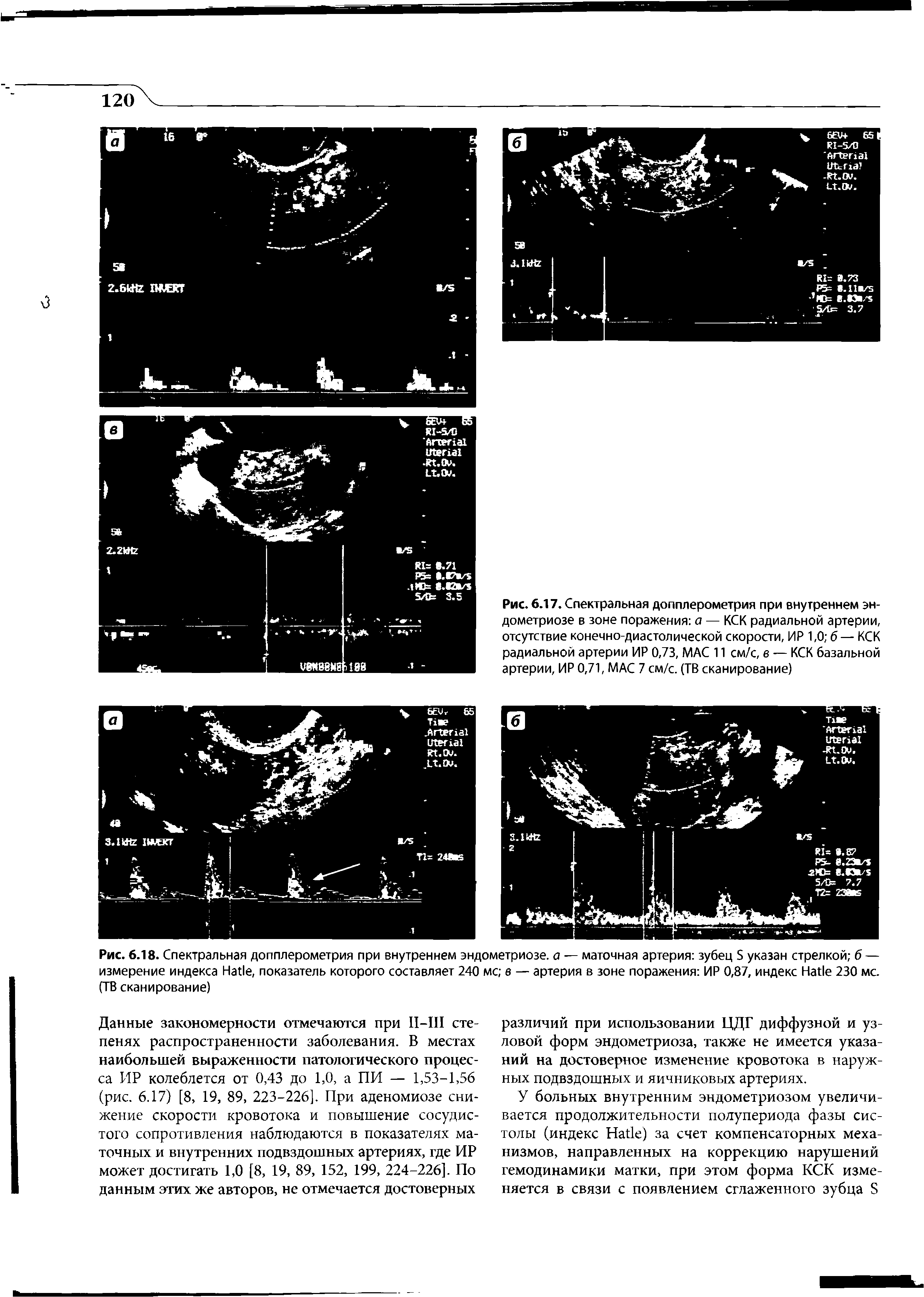 Рис. 6.18. Спектральная допплерометрия при внутреннем эндометриозе, а — маточная артерия зубец S указан стрелкой б — измерение индекса H , показатель которого составляет 240 мс в — артерия в зоне поражения ИР 0,87, индекс H 230 мс. (ТВ сканирование)...