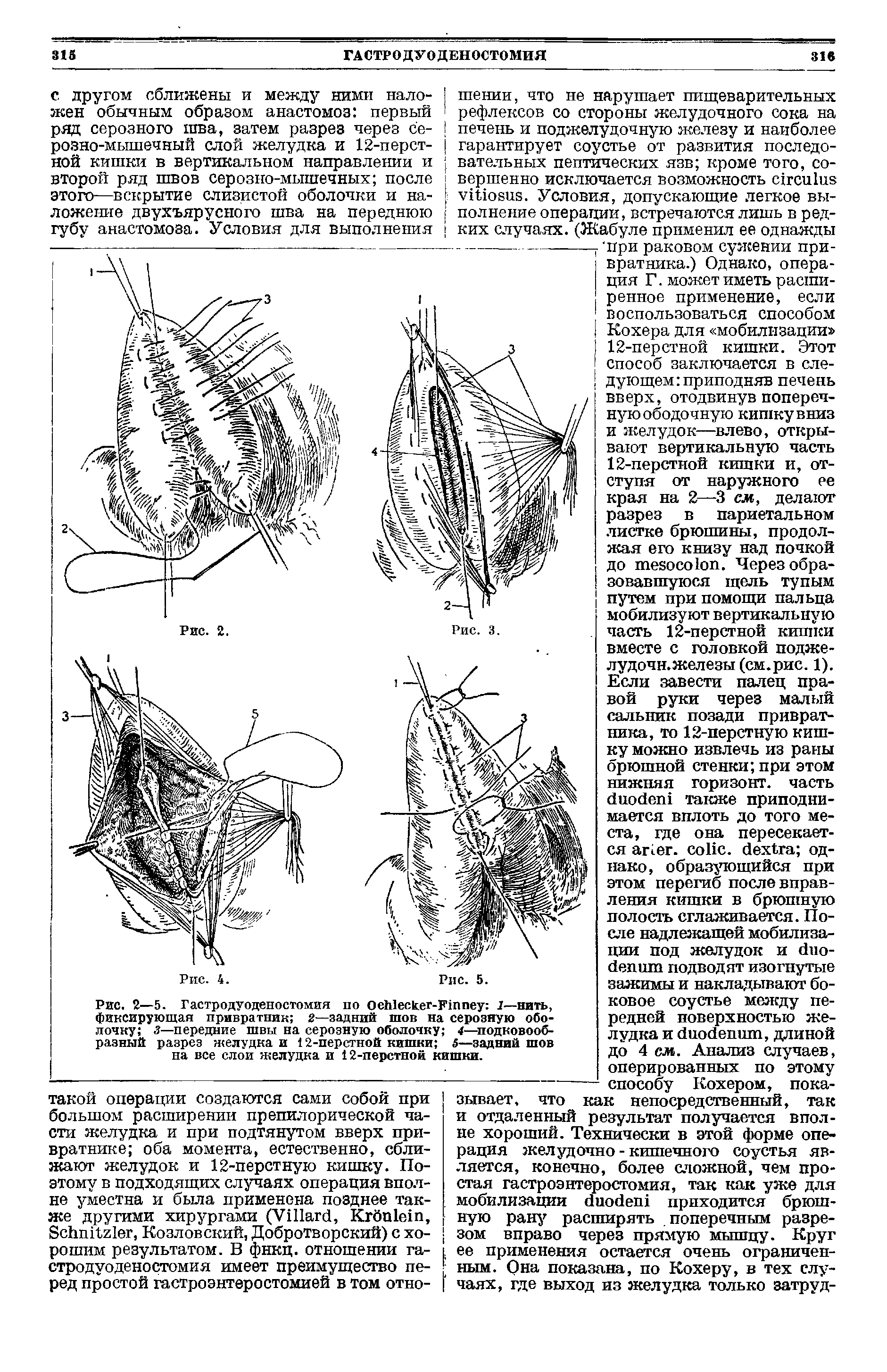 Рис. 2—5. Гастродуоденостомия по ОеЫескег-Иппеу 1—нить, фиксирующая привратник 2—задний шов на серозную оболочку з—передние швы на серозную оболочку 4—подковообразный разрез желудка и 12-перстной кишки 5—задний шов на все слои желудка и 12-перстной кишки.