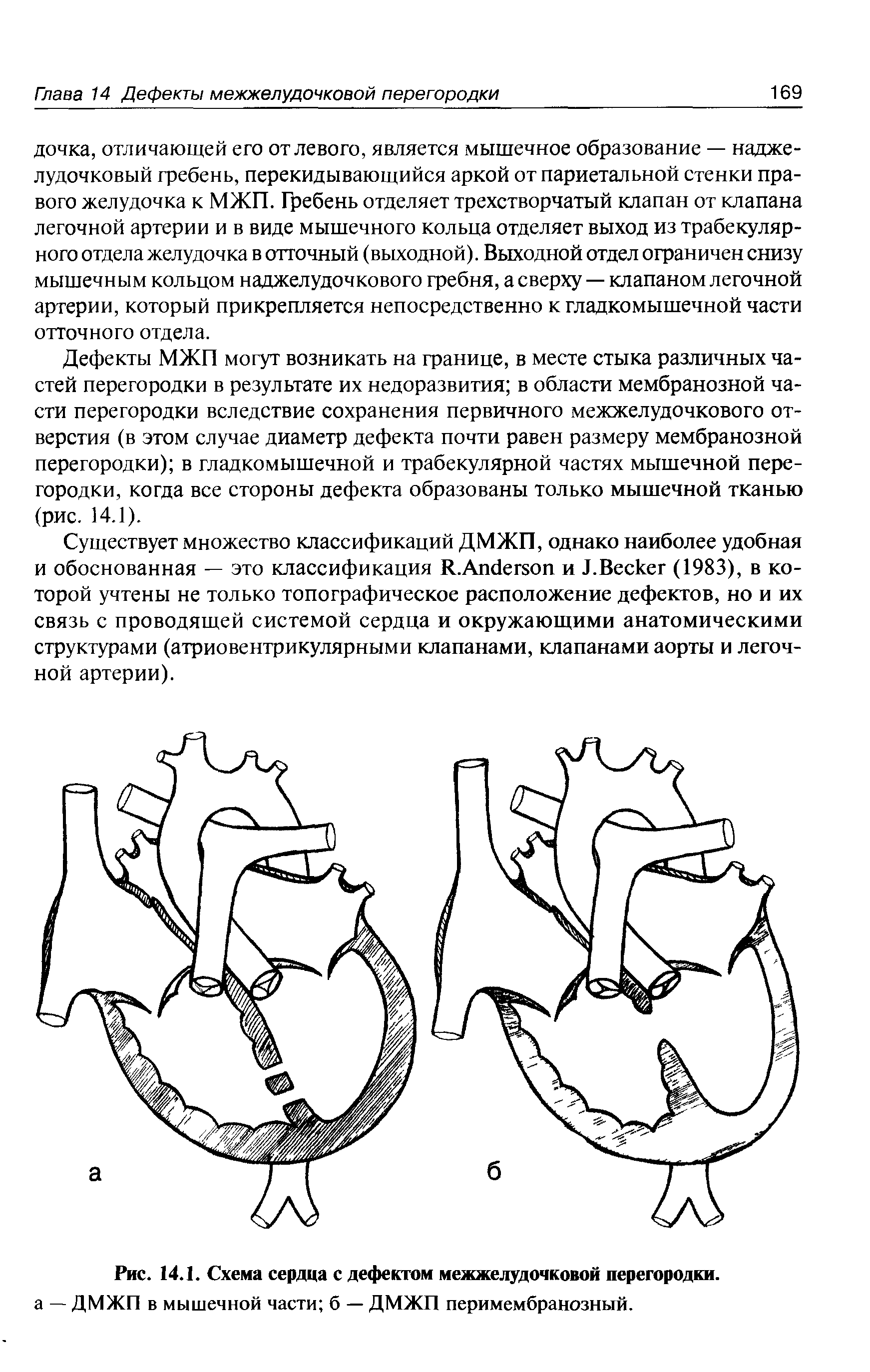 Рис. 14.1. Схема сердца с дефектом межжелудочковой перегородки, а — ДМЖП в мышечной части б — ДМЖП перимембранозный.