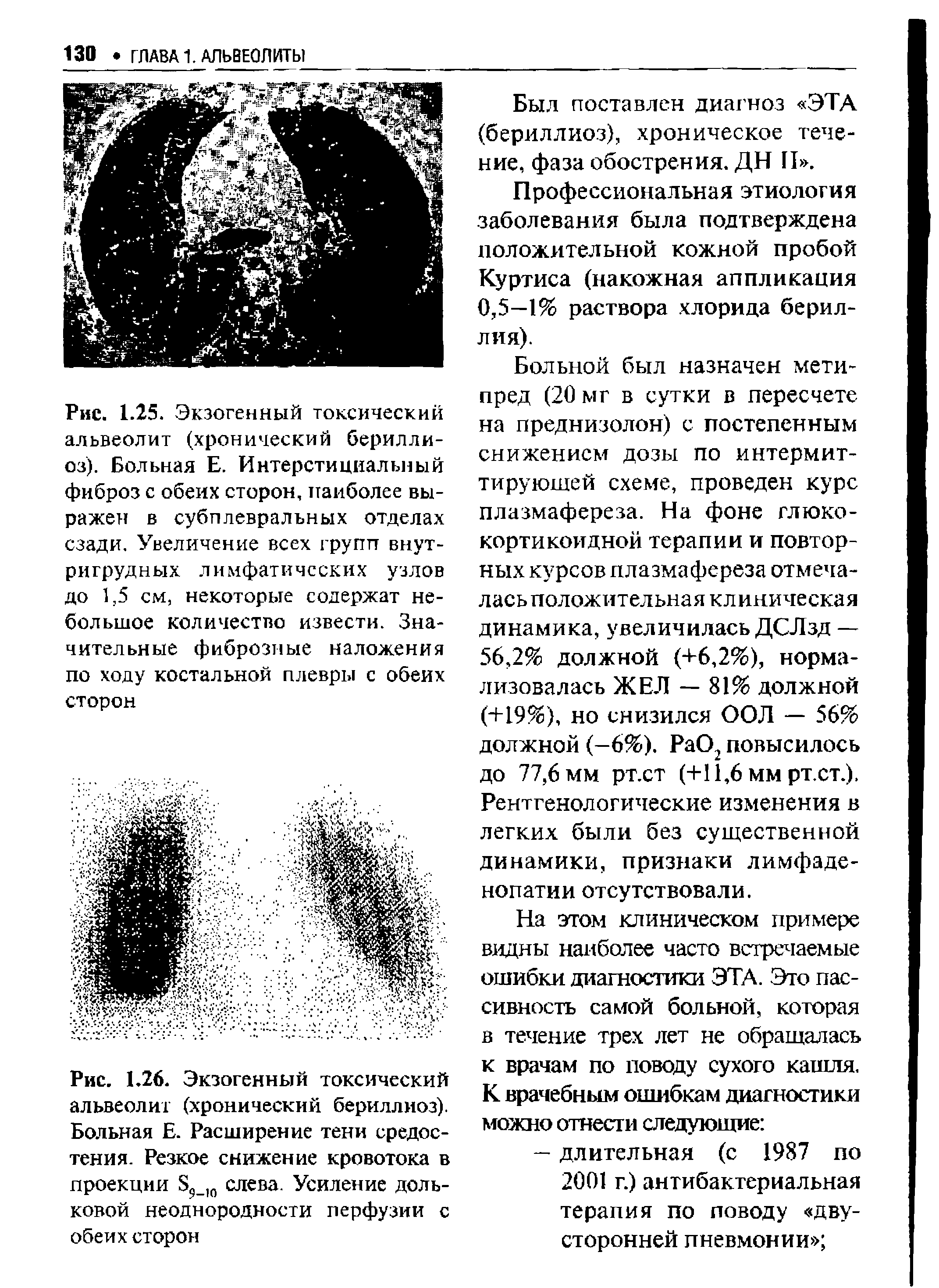 Рис. 1.25. Экзогенный токсический альвеолит (хронический берилли-оз). Больная Е. Интерстициальный фиброз с обеих сторон, наиболее выражен в субплевралъных отделах сзади. Увеличение всех групп внут-ригрудных лимфатических узлов до 1,5 см, некоторые содержат небольшое количество извести. Значительные фиброзные наложения по ходу костальной плевры с обеих...