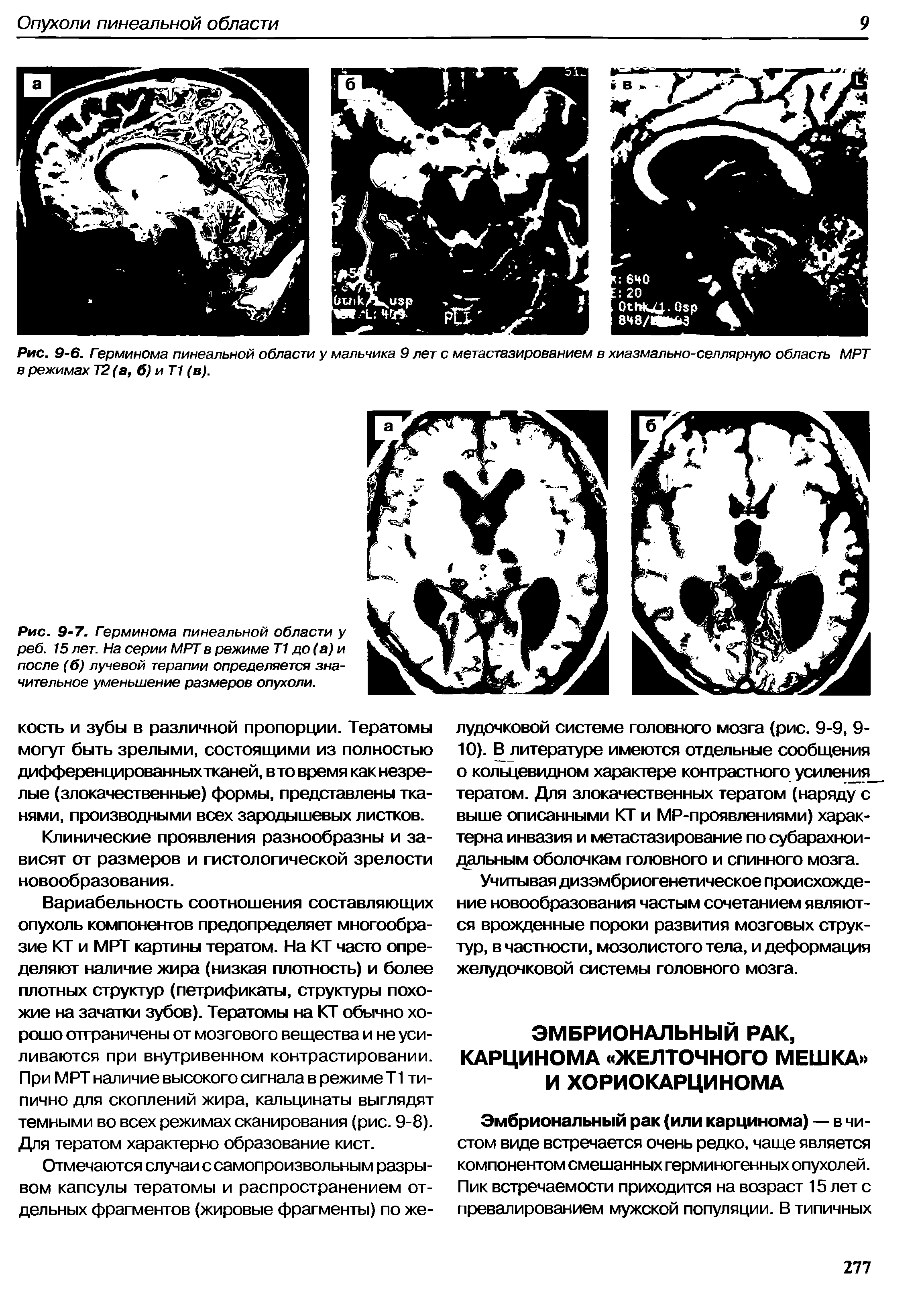 Рис. 9-7. Герминома пинеальной области у реб. 15 лет. На серии МРТ в режиме Т1 до (а) и после (б) лучевой терапии определяется значительное уменьшение размеров опухоли.