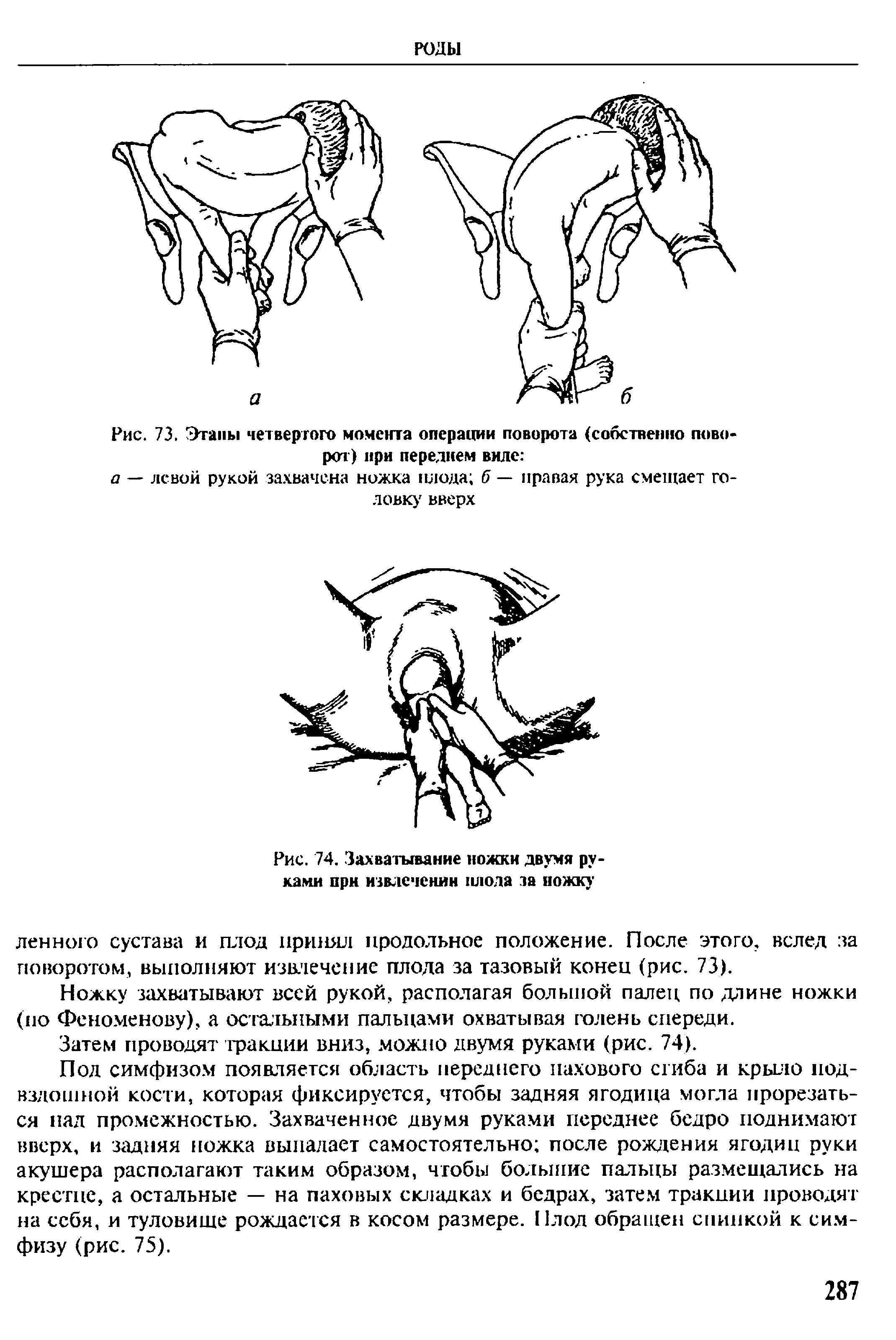 Рис. 74. Захватывание ножки двумя руками при извлечении плода за ножку...
