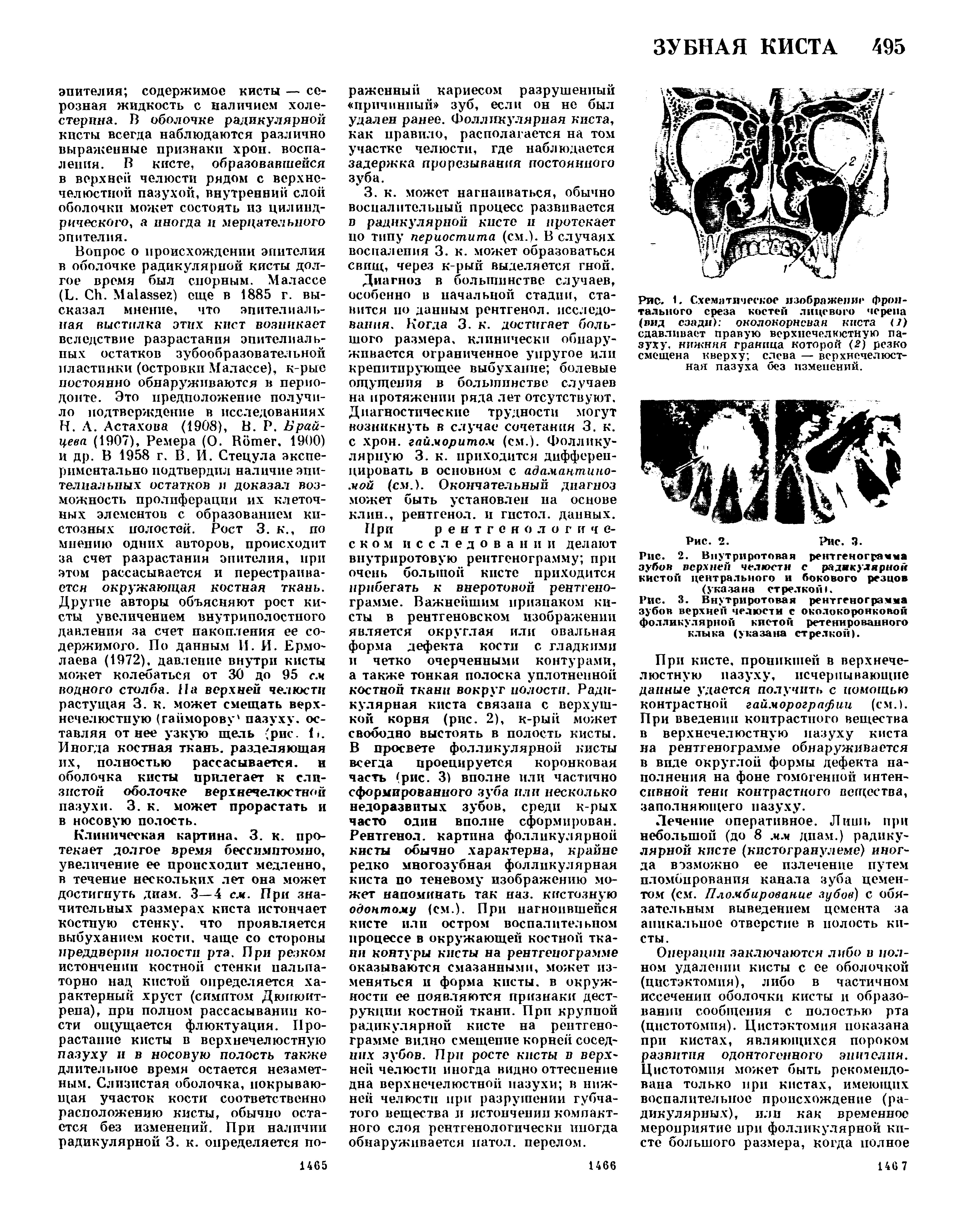 Рис. 1. Схематическое изображение фронтального среза костей лицевого черепа (вид сзади) околокорневая киста ( ) сдавливает правую верхнечелюстную пазуху. нижняя граница которой (2) резко смещена кверху слева — верхнечелюстная пазуха без изменений.