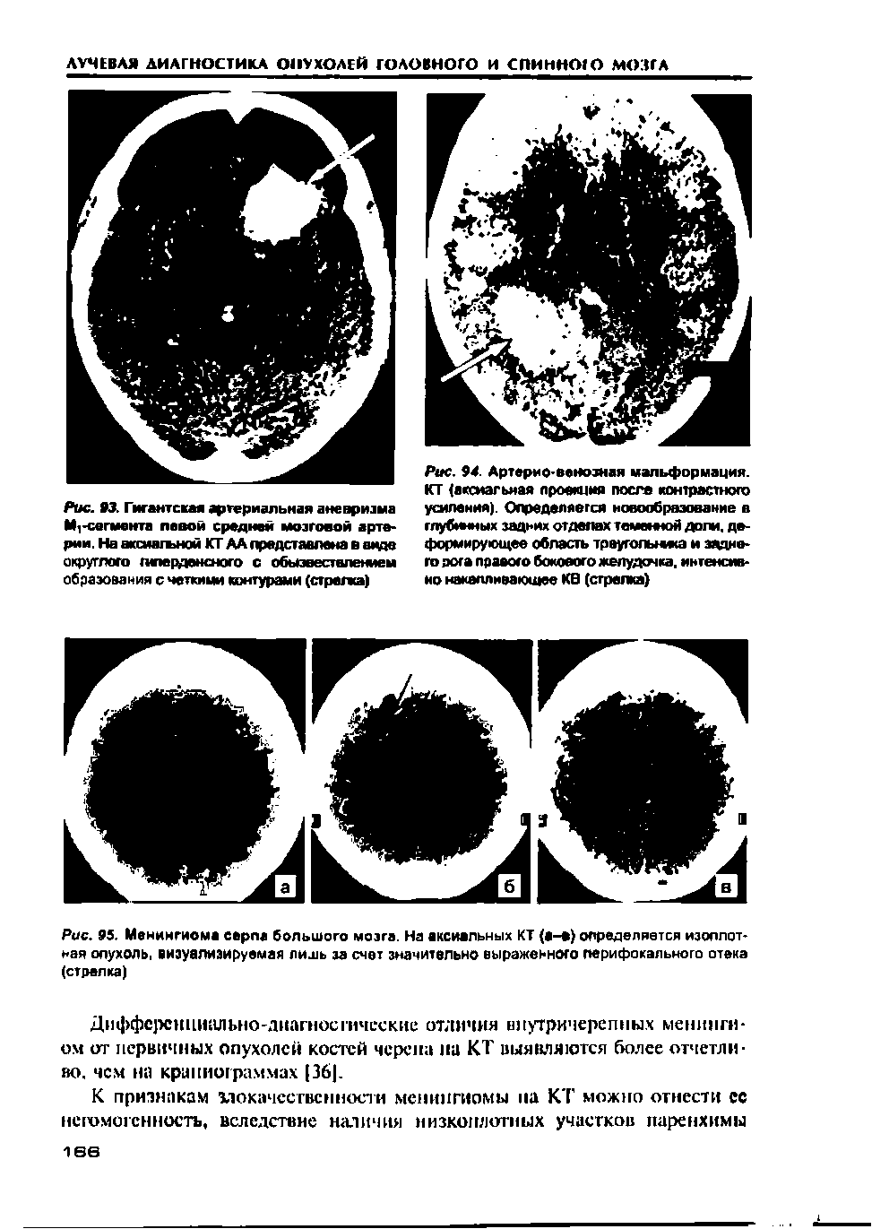 Рис. 95. Менингиома серпа большого мозга. На аксиальных КТ (а-В) определяется изоплот-ная опухоль, визуализируемая лишь за счет значительно выраженного перифокального отека (стрелка)...