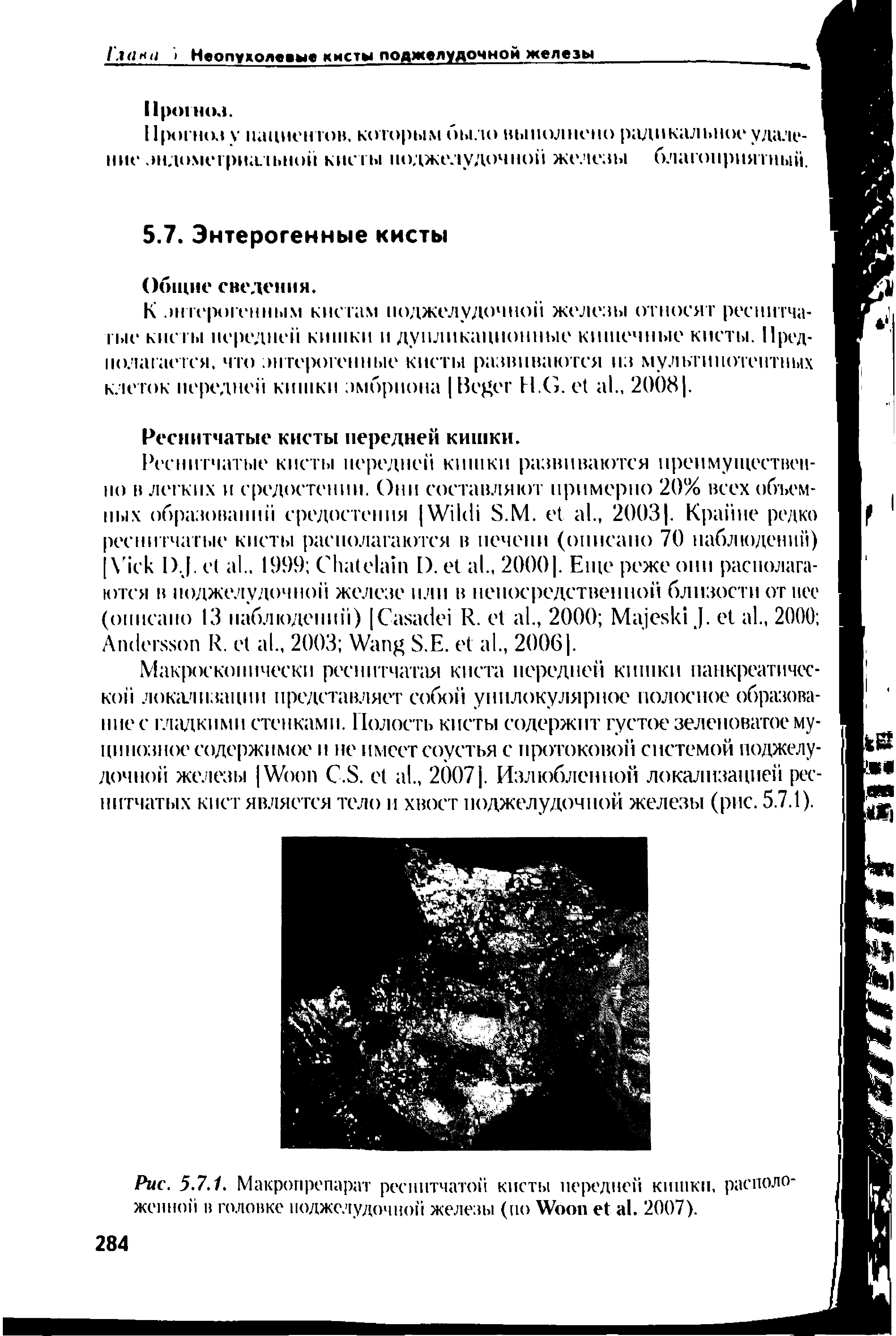 Рис. 5.7.1. Макропрепарат реснитчатой кисты передней кишки, расположенной в головке поджелудочной железы (но W . 2007).