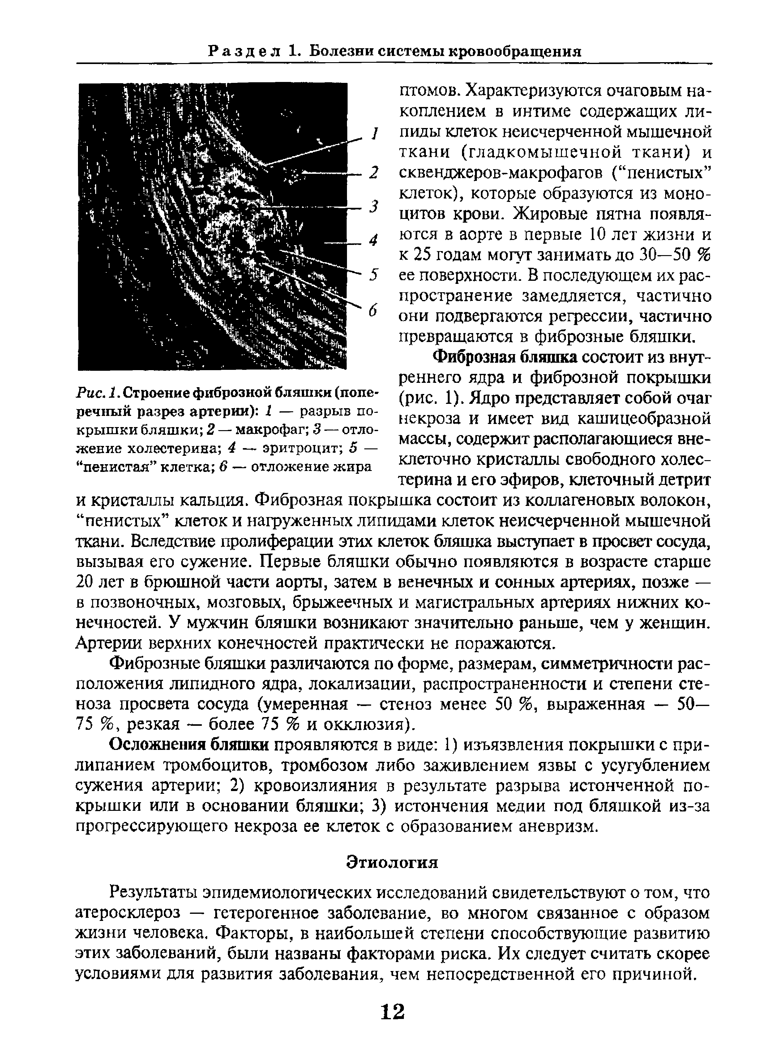 Рис. 1. Строение фиброзной бляшки (поперечный разрез артерии) 1 — разрыв покрышки бляшки 2 — макрофаг 3 — отложение холестерина 4 — эритроцит 5 — пенистая клетка 6 — отложение жира...