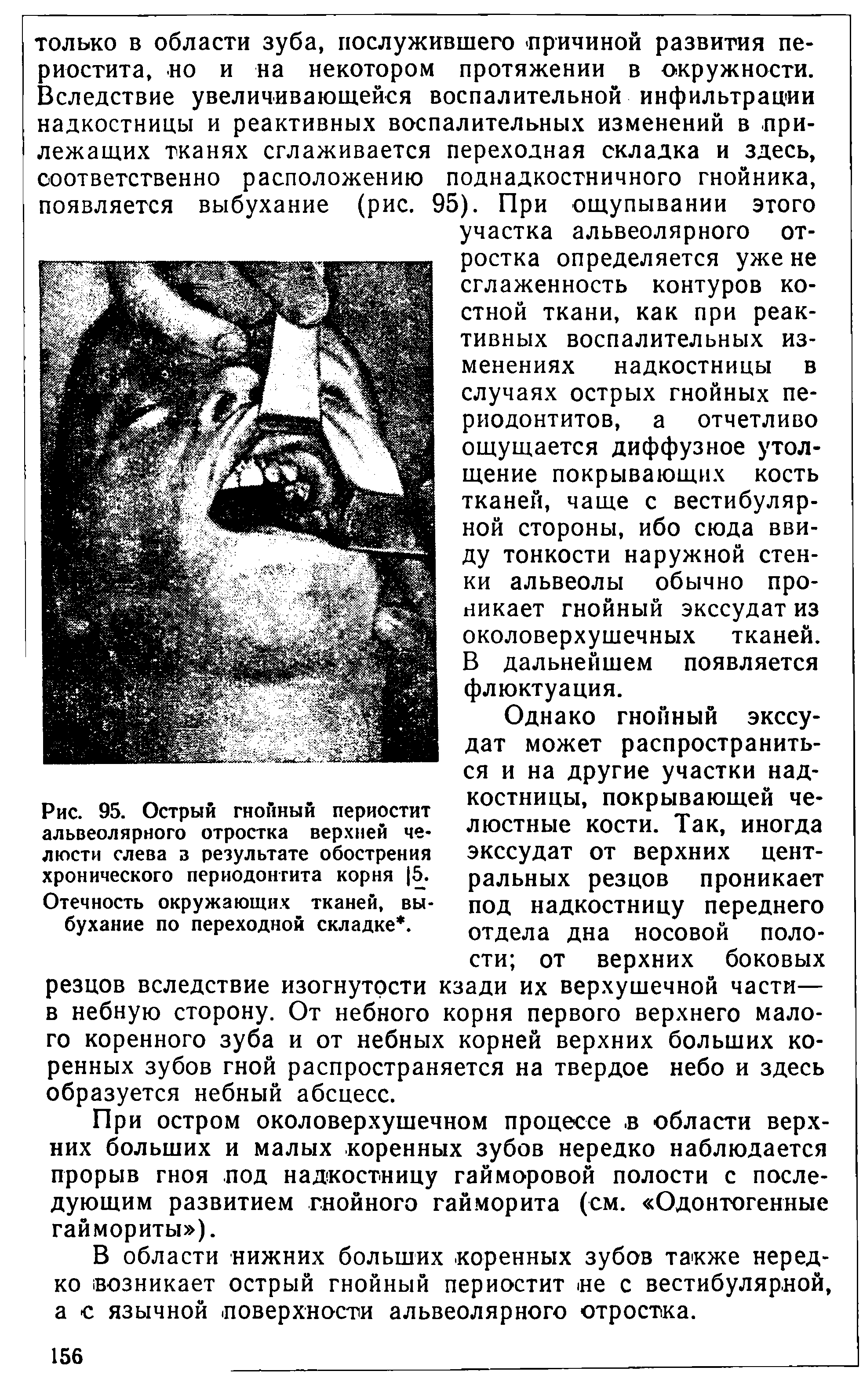 Рис. 95. Острый гнойный периостит альвеолярного отростка верхней челюсти слева з результате обострения хронического периодонтита корня 5. Отечность окружающих тканей, выбухание по переходной складке. ...