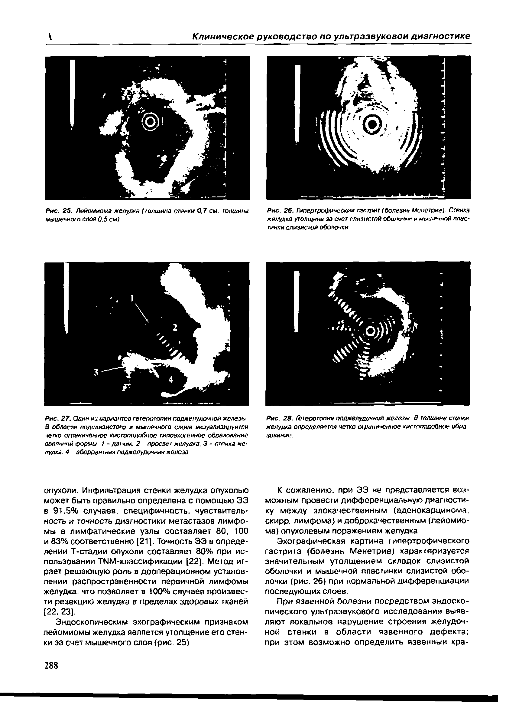 Рис. 25. Лейомиома желудки /толщина стенки 0,7 см. толщина мыи/ечягмп слоя 0.5 см)...