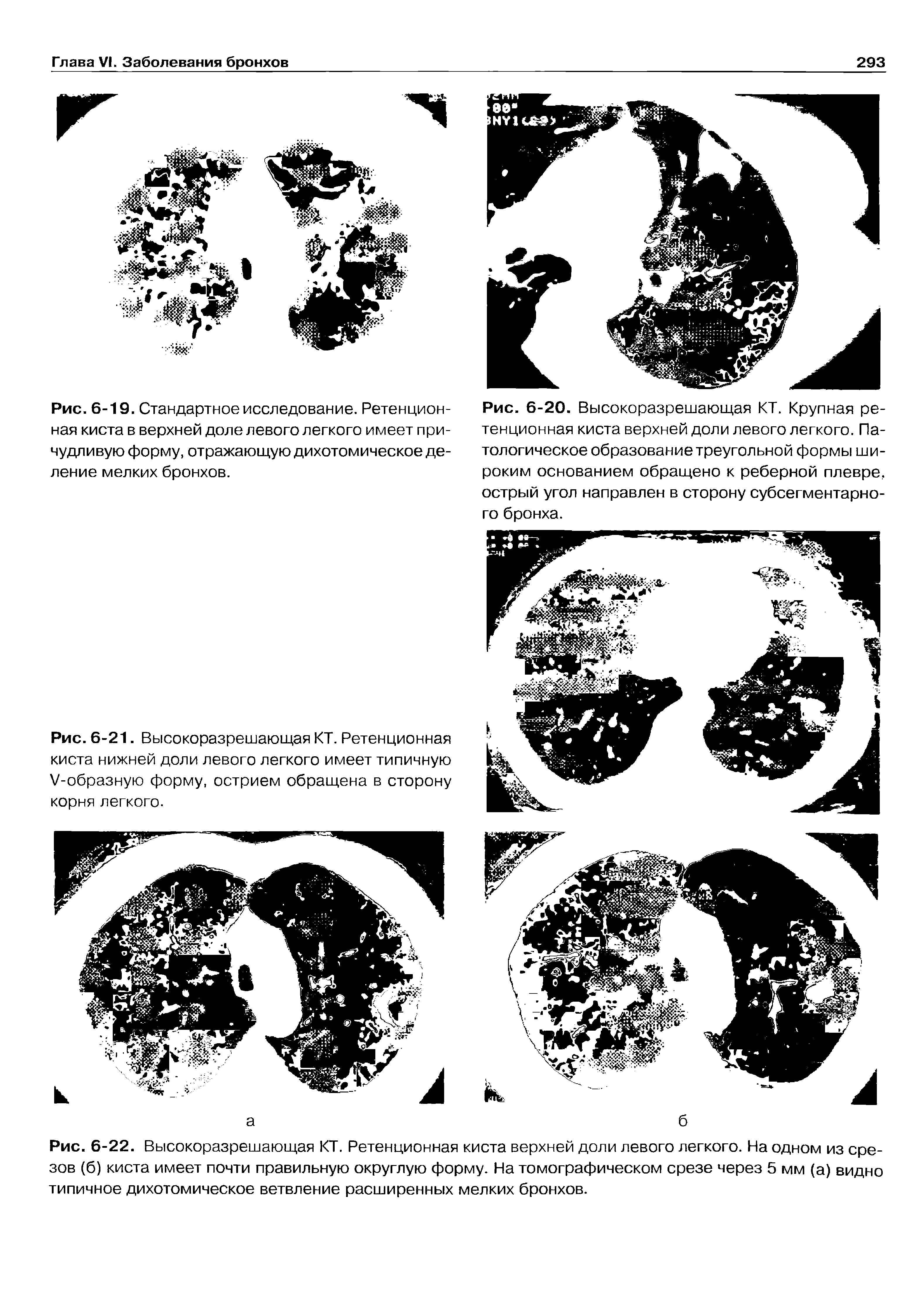 Рис. 6-22. Высокоразрешающая КТ. Ретенционная киста верхней доли левого легкого. На одном из срезов (б) киста имеет почти правильную округлую форму. На томографическом срезе через 5 мм (а) видно типичное дихотомическое ветвление расширенных мелких бронхов.