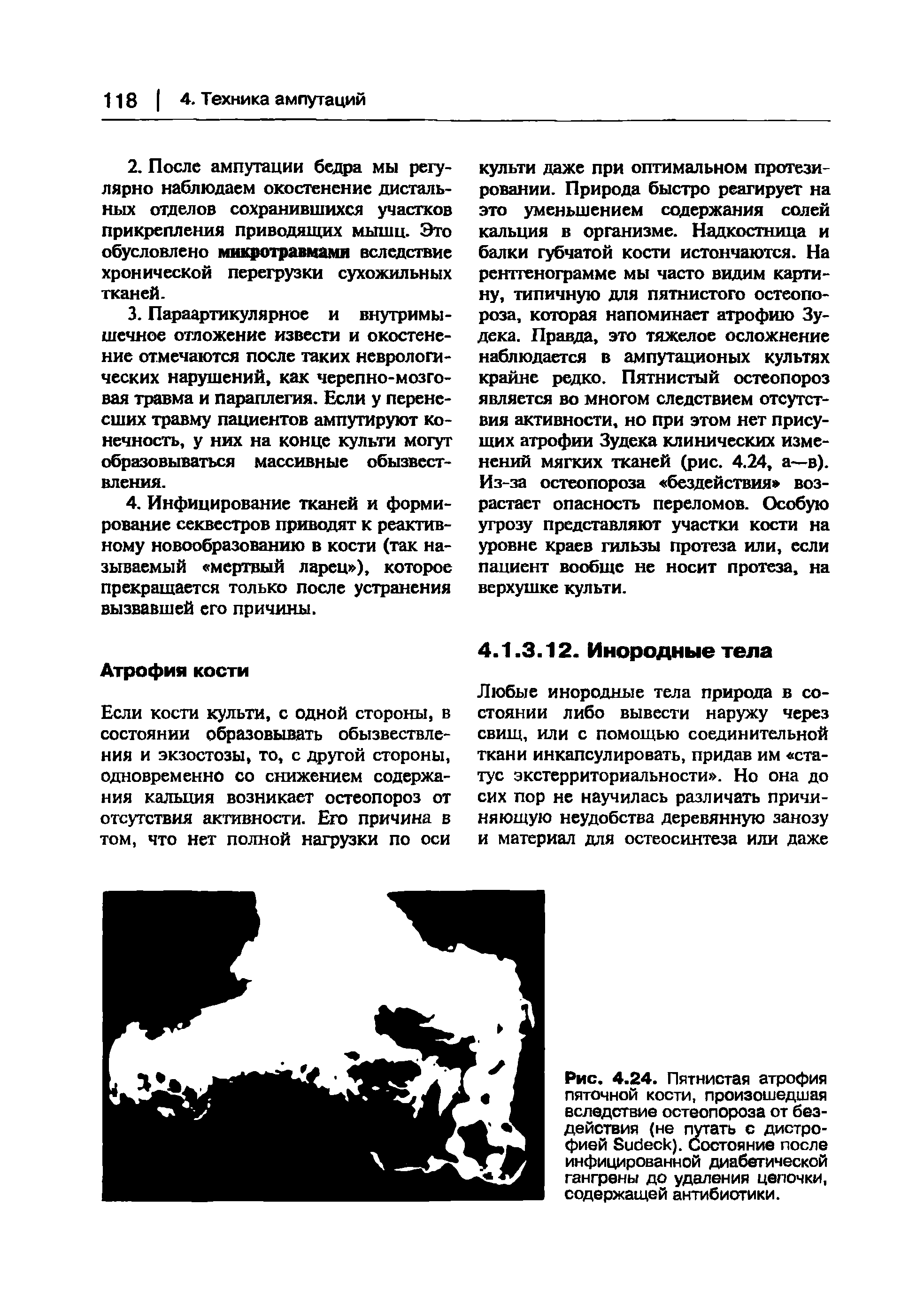 Рис. 4.24. Пятнистая атрофия пяточной кости, произошедшая вследствие остеопороза от бездействия (не путать с дистрофией Бибеск). Состояние после инфицированной диабетической гангрены до удаления цепочки, содержащей антибиотики.