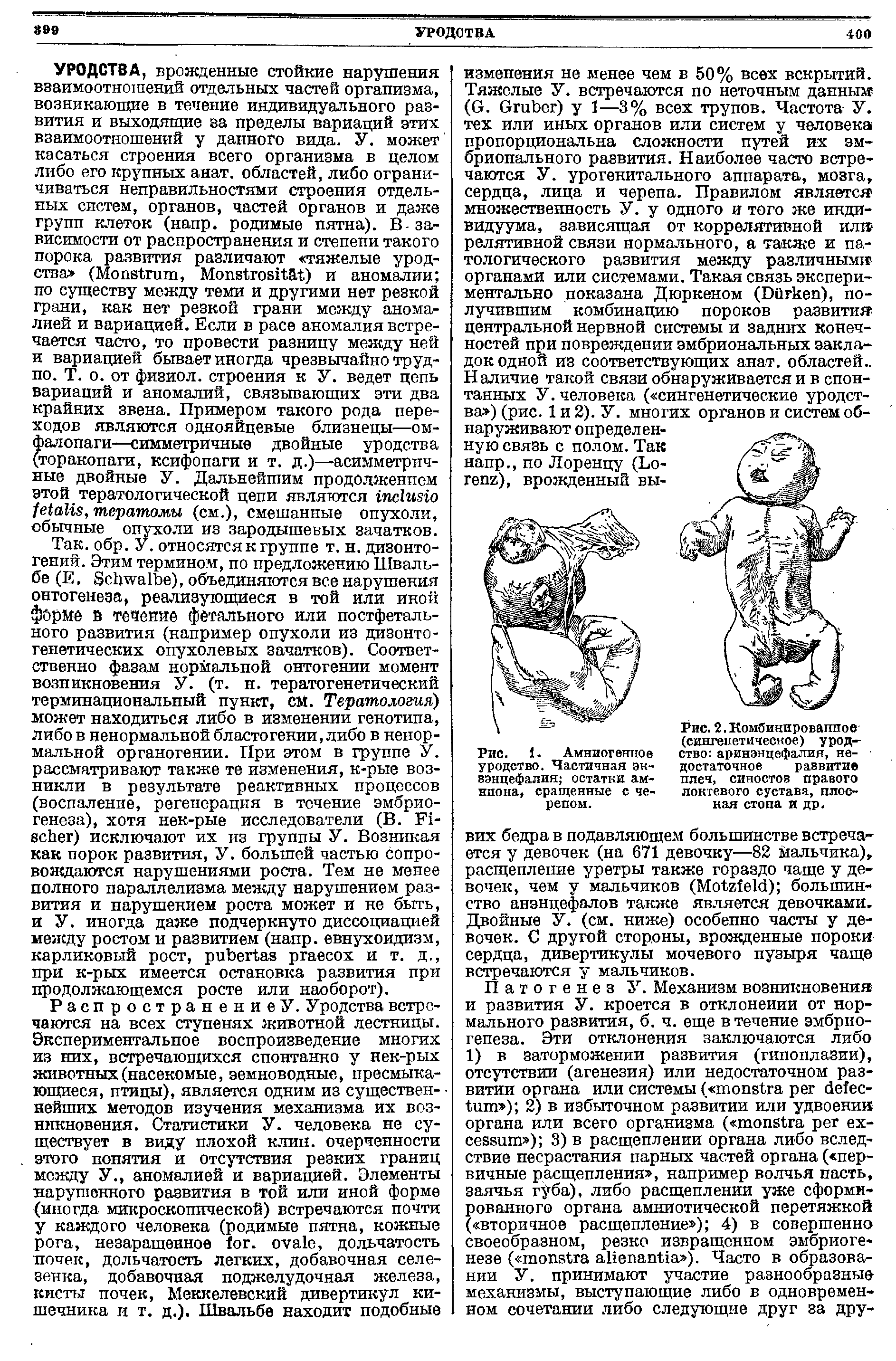 Рис. 2. Комбинированное (сингенетическое) уродство аринэнцефалия, недостаточное развитие плеч, синостоз правого локтевого сустава, плоская стопа и др.