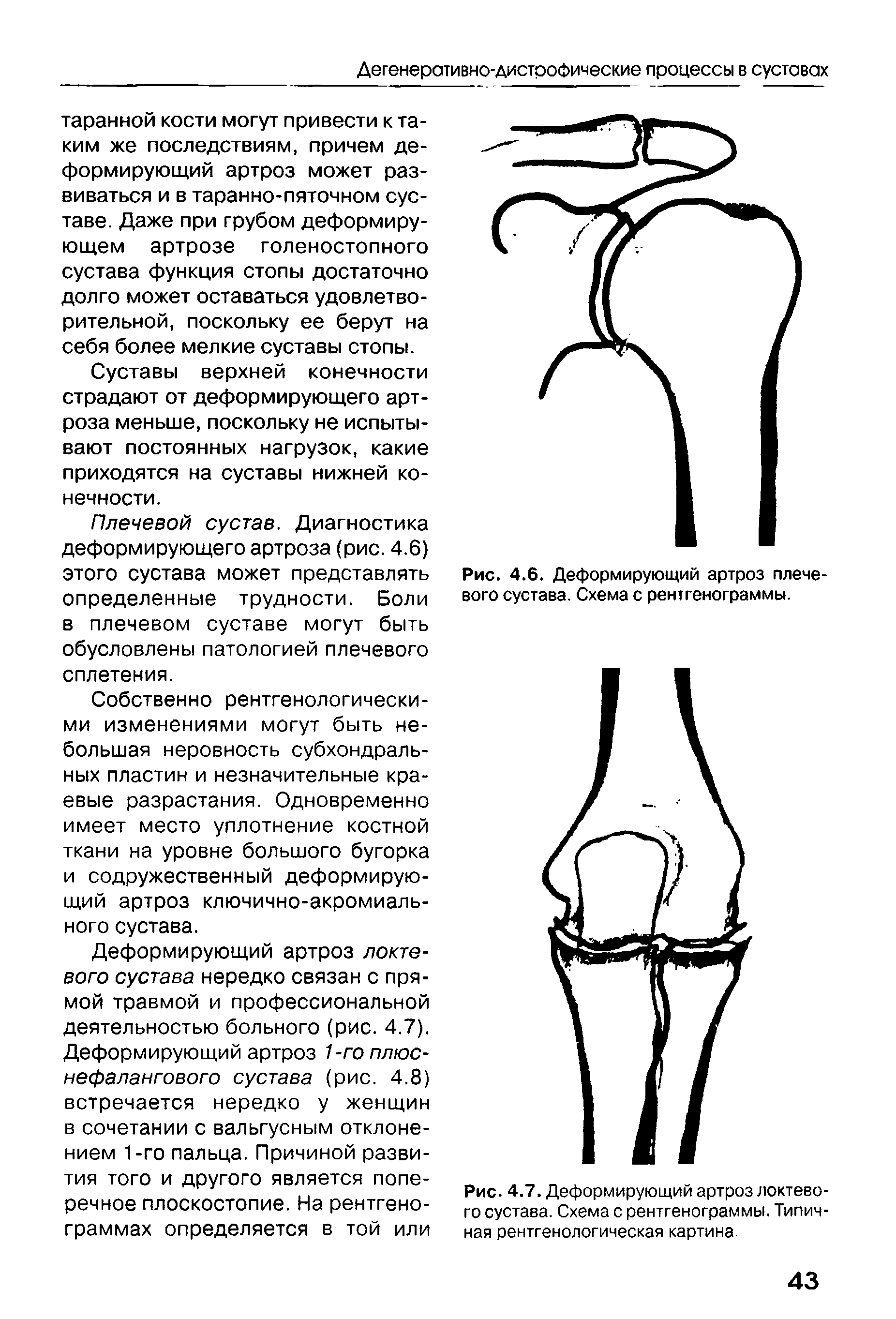 Рис. 4.7. Деформирующий артроз локтевого сустава. Схема с рентгенограммы. Типичная рентгенологическая картина.