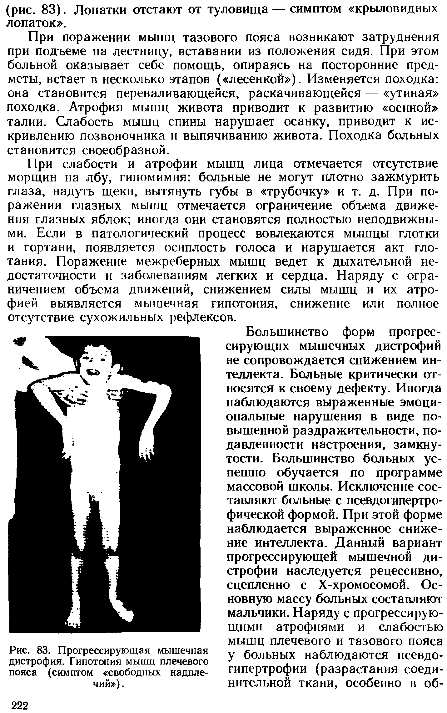 Рис. 83. Прогрессирующая мышечная дистрофия. Гипотония мышц плечевого пояса (симптом свободных надплечий ).