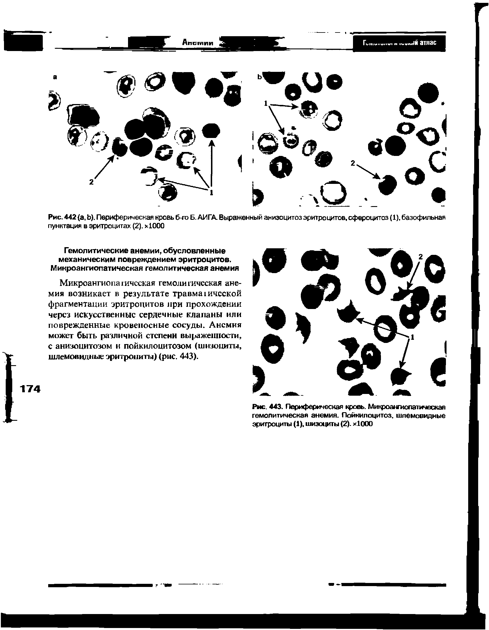 Рис. 443. Периферическая кровь. Микроангиопатическая гемолитическая анемия. Пойкилоцитоз, шлемовидные эритроциты (1), шизоциты (2). х1000...