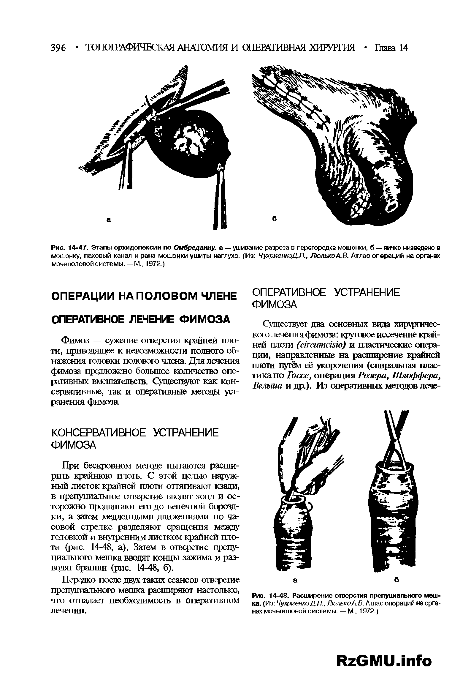 Рис. 14-47. Этапы орхидопексии по Омбреданну. а — ушивание разреза в перегородке мошонки, б — яичко низведено в мошонку, паховый канал и рана мошонки ушиты наглухо, (на ЧухриенкоД.П., ЛюлькоА.В. Атлас операций на органах мочеполовой системы.—М., 1972.)...