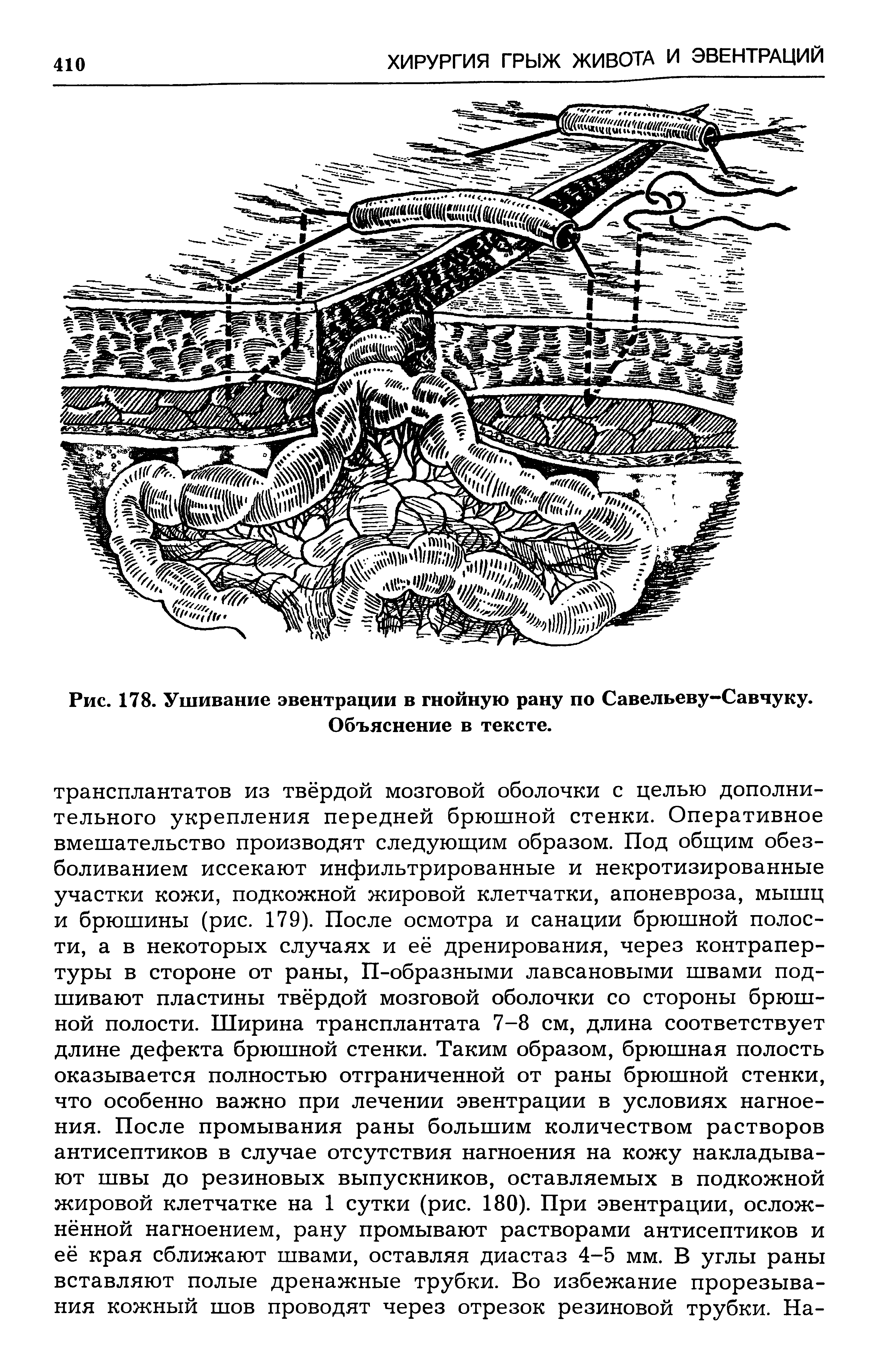 Рис. 178. Ушивание эвентрации в гнойную рану по Савельеву-Савчуку. Объяснение в тексте.