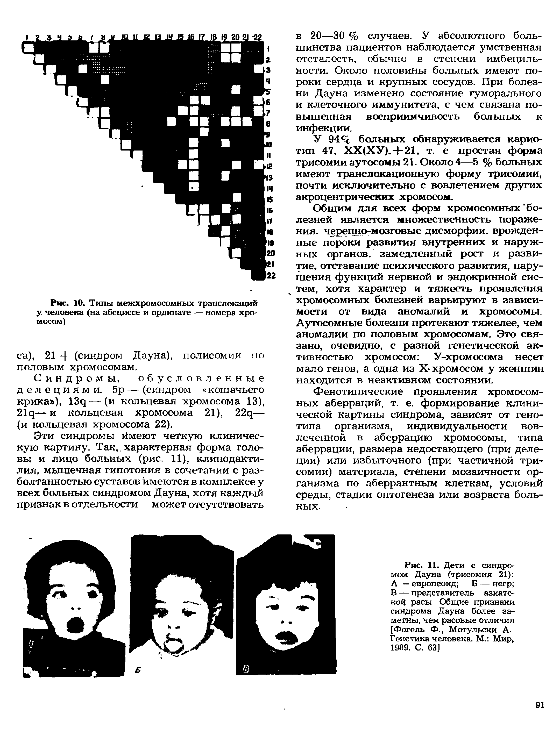 Рис. 11. Дети с синдромом Дауна (трисомия 21) А — европеоид Б — негр В — представитель азиатской расы Общие признаки синдрома Дауна более заметны, чем расовые отличия [Фогель Ф., Мотульски А. Генетика человека. М. Мир, 1989. С. 63]...