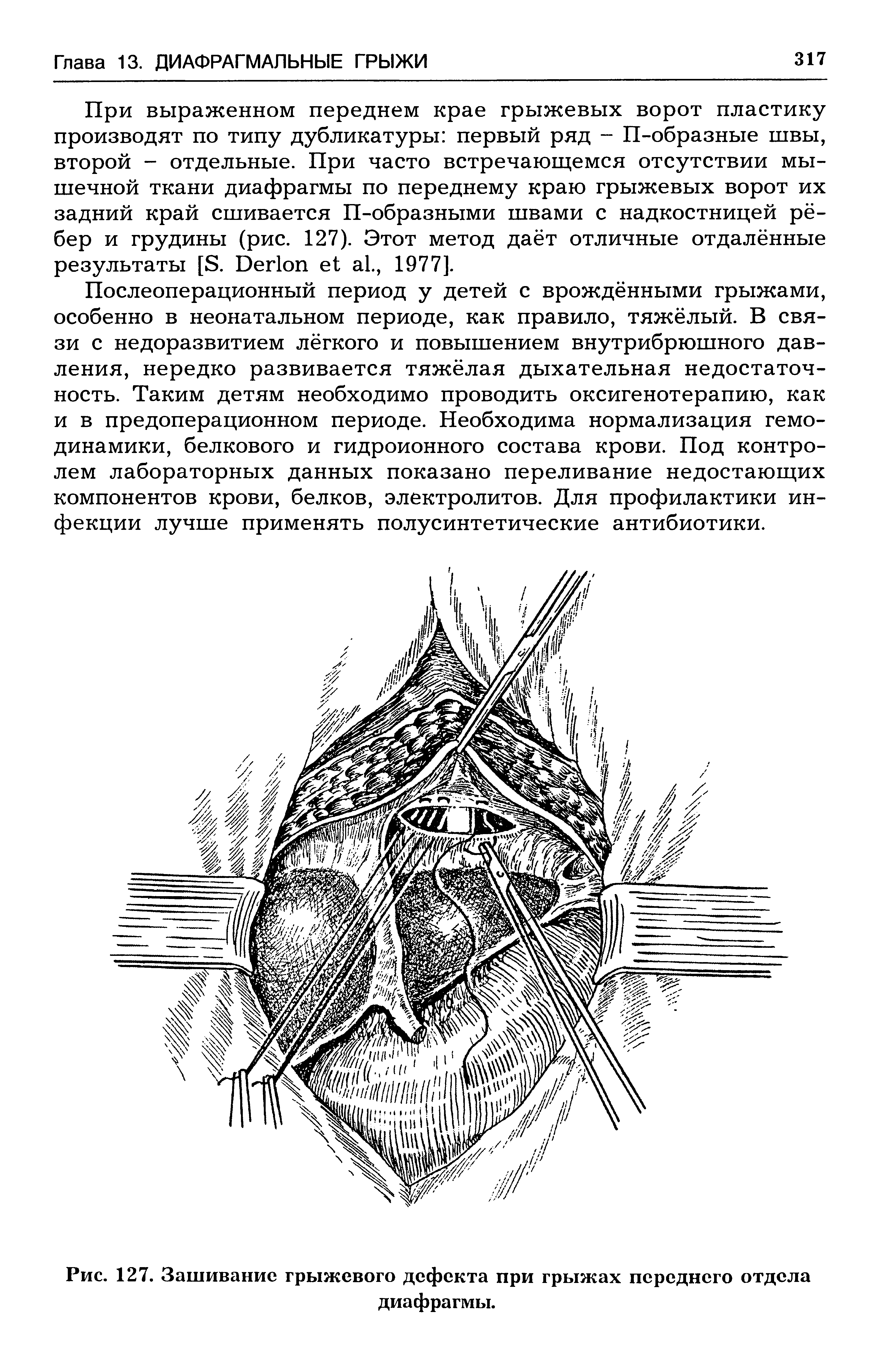 Рис. 127. Зашивание грыжевого дефекта при грыжах переднего отдела диафрагмы.